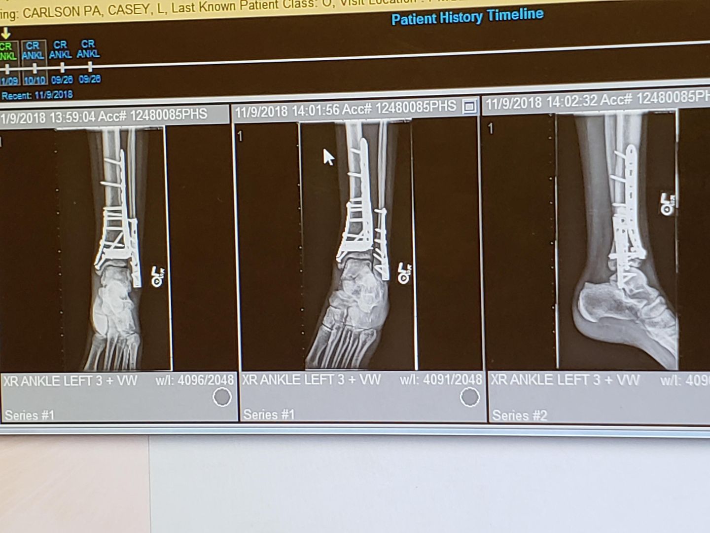 I broke my tibia and fibula down to the ankle joint (pilon fracture), 15 screws and 3 plates