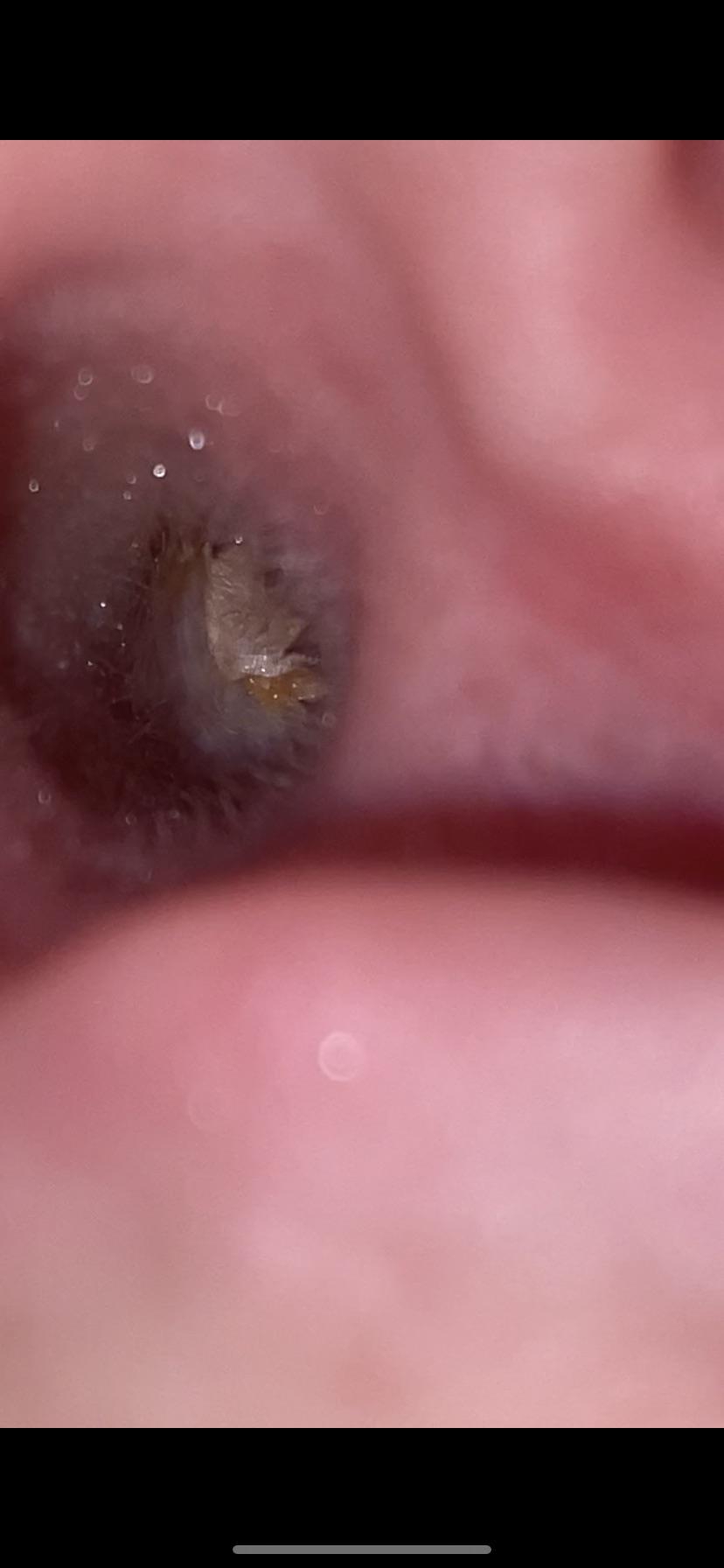 I can’t hear with my left ear. This is how it looks currently. Is it earwax blockage?