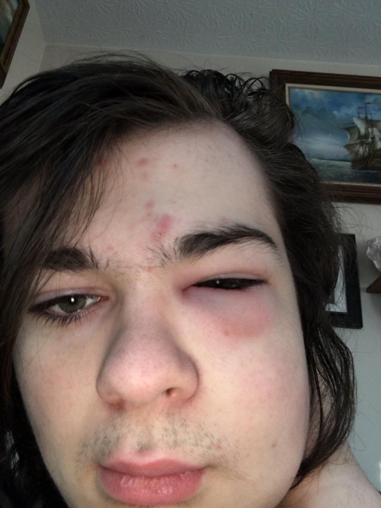 I got bell’s palsy on Monday and wasn’t able to see a doctor until Wednesday