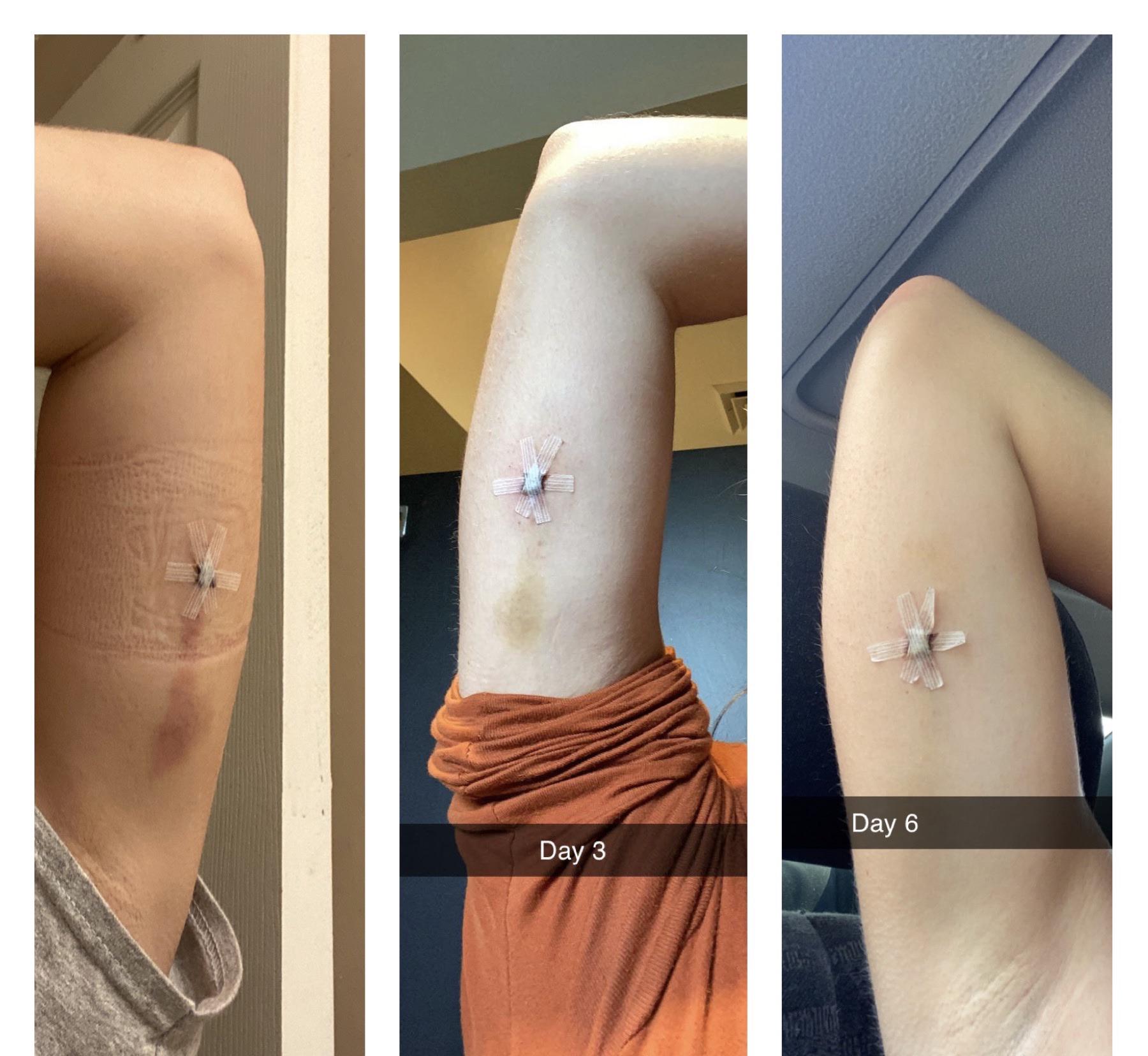 I got the Nexplanon implant 6 days ago. This is the bruising from the ...