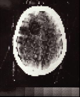 Image of the first clinical CT scan on a patient with a suspected ...