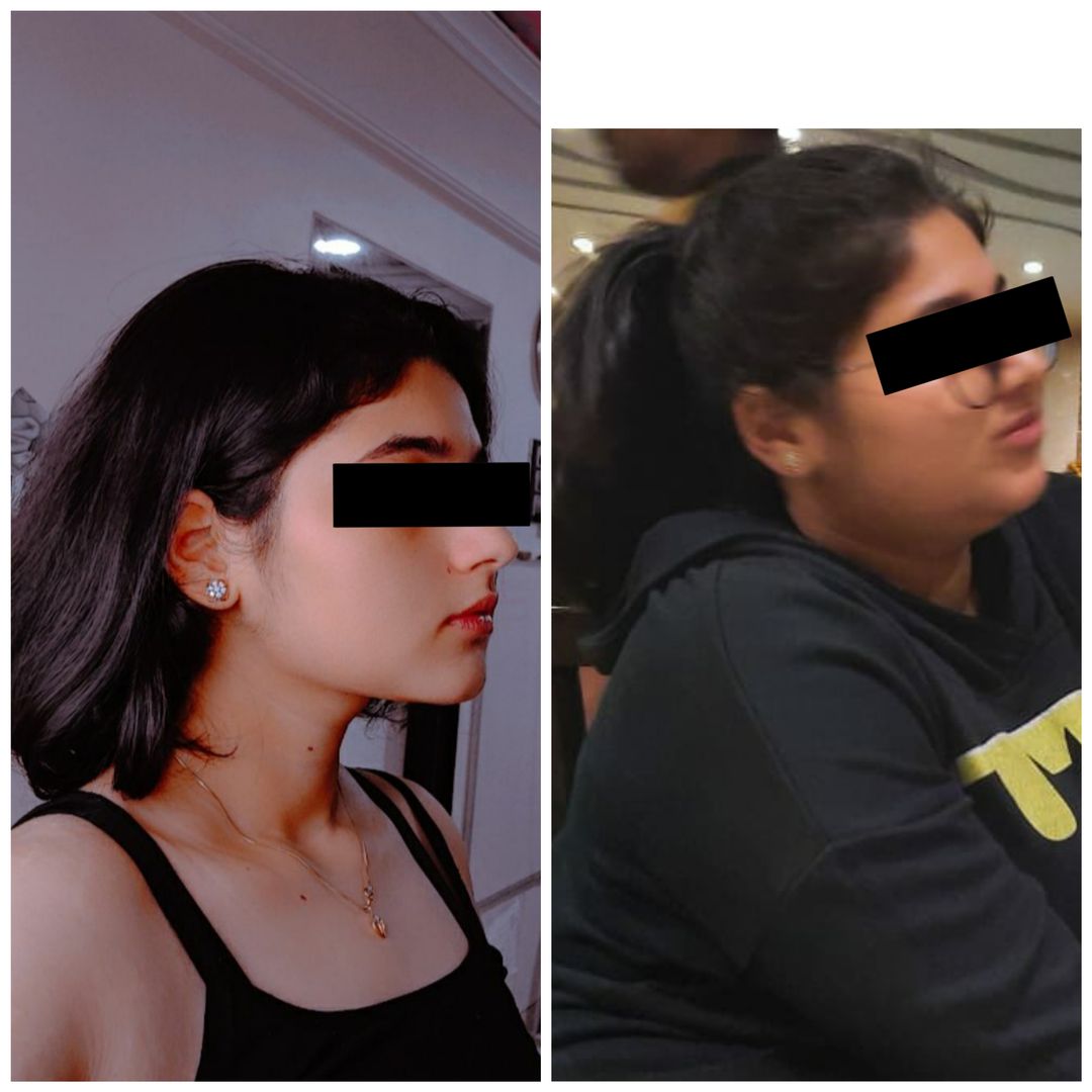jawline gains ✨ 20 kgs down (5'2 58 kg) trying to lose 10 more 🙌