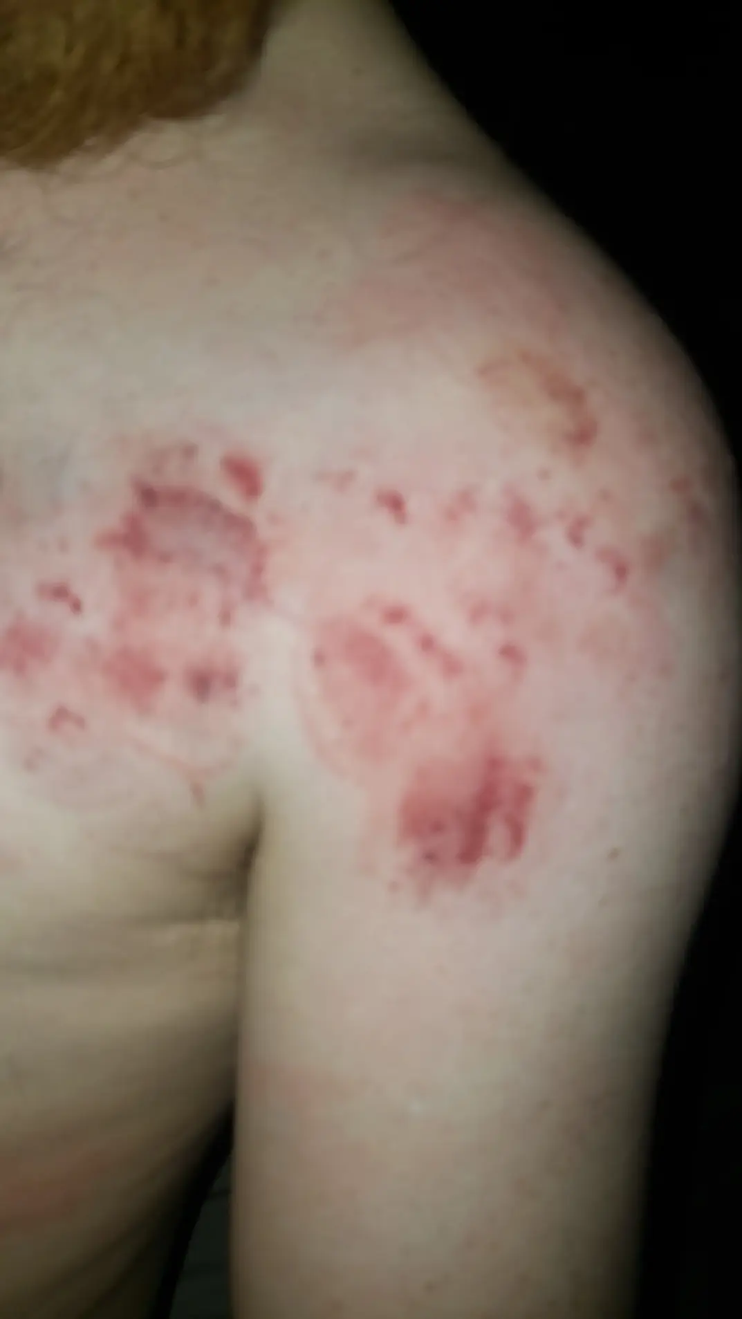 Discover more like Bitemarks: Like the marks I left on my partner? and ...