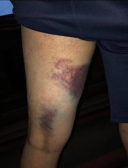 My dad pulled his hamstring while roller skating then went hiking on a mile and a half trail this is the aftermath
