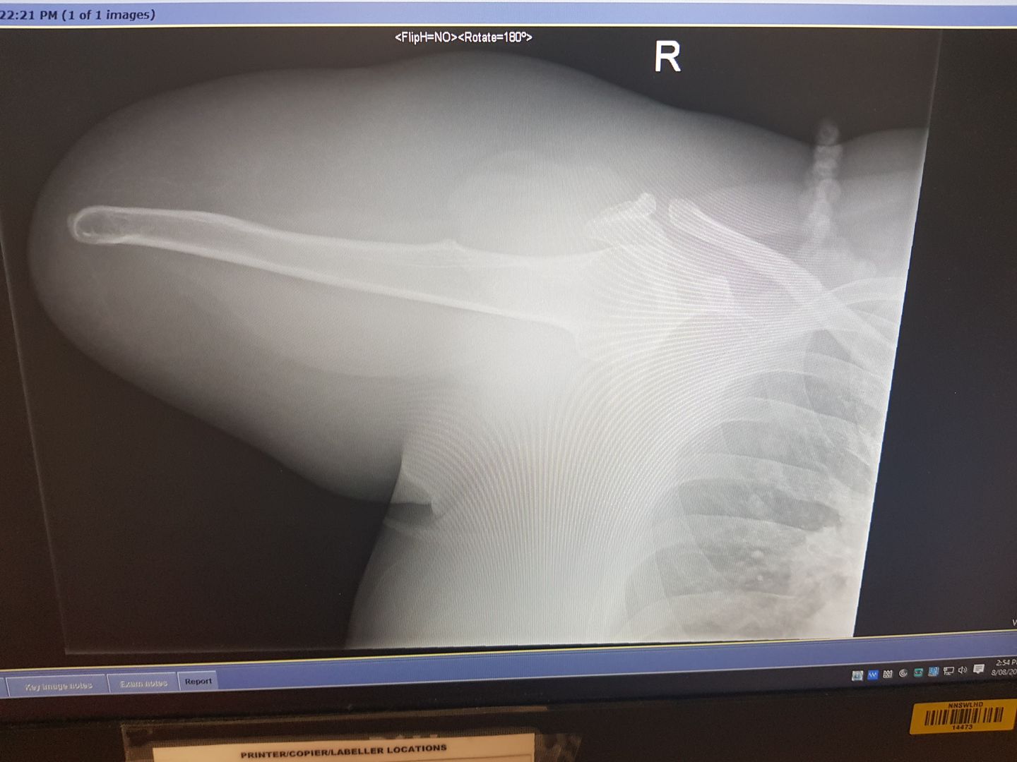 My friend had an X-Ray taken of her arm stump recently... most interesting to see the inside!