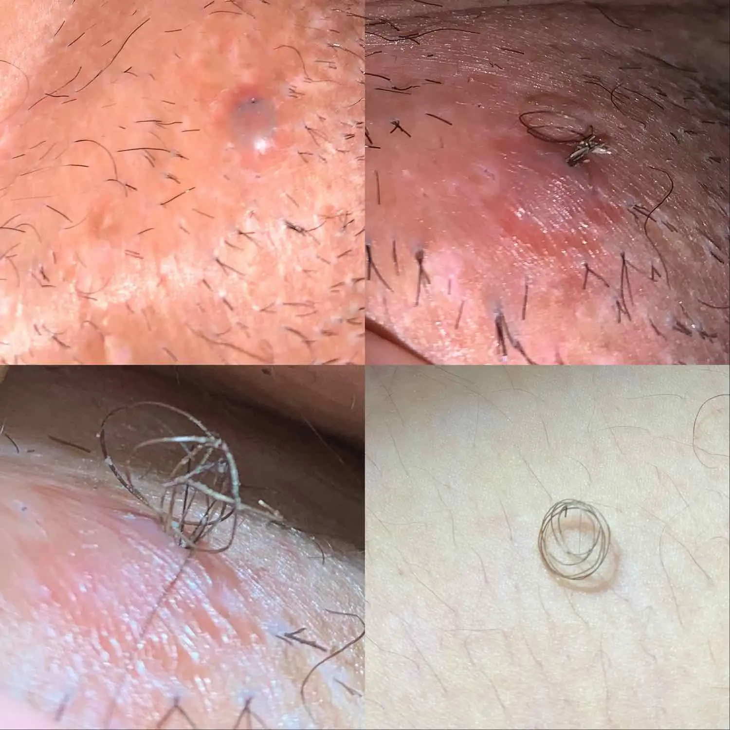 Never-ending ingrown hair!