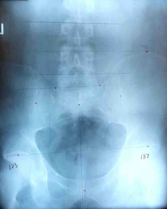 Nothing that special. Just my super messed up alignment.