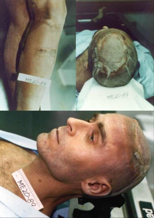 Photos of Ted Bundy after being electrocuted via electric chair (kinda creeps me out how he doesn’t even look dead here)