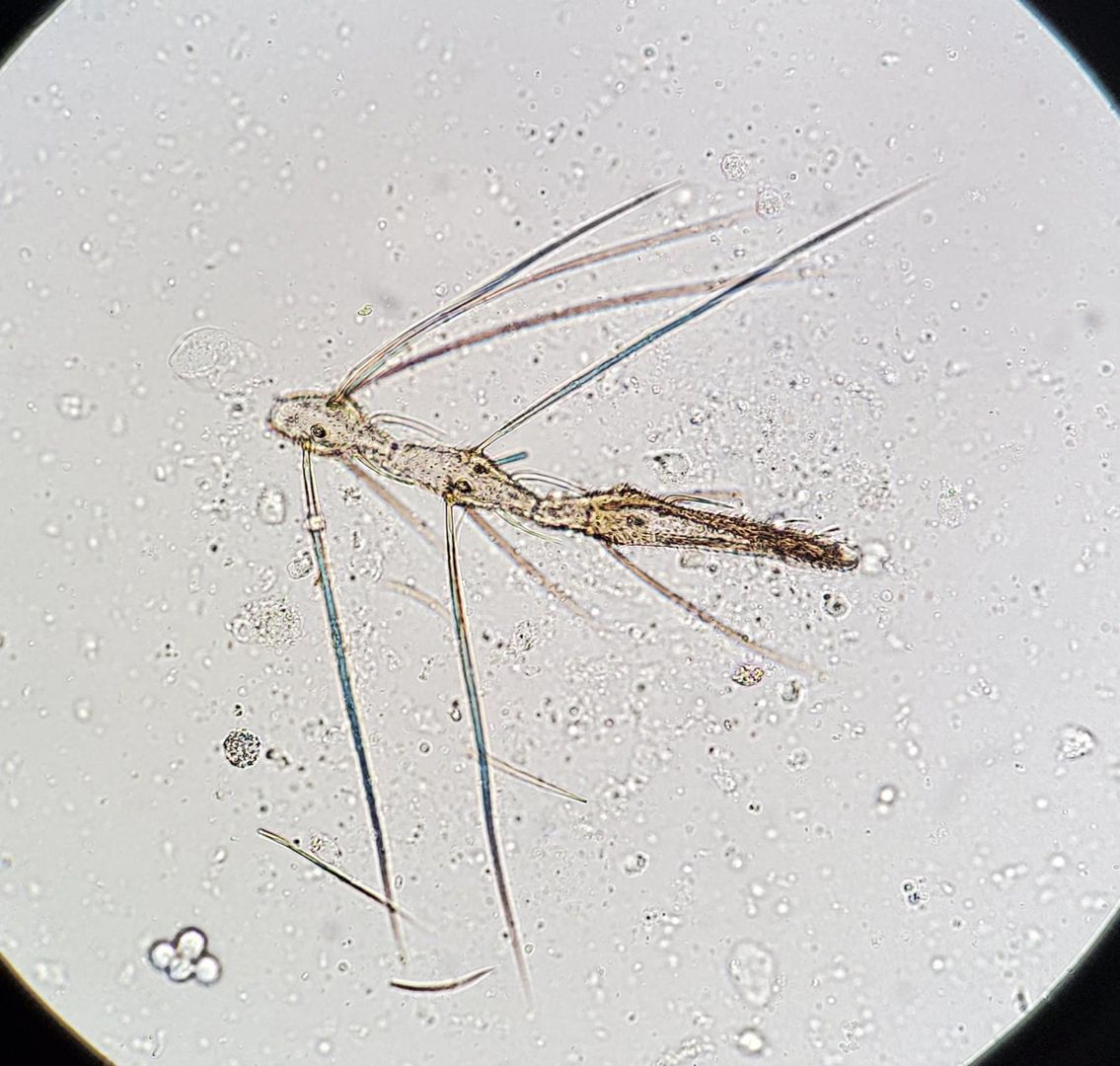 Post vasectomy specimen. Microscope image.