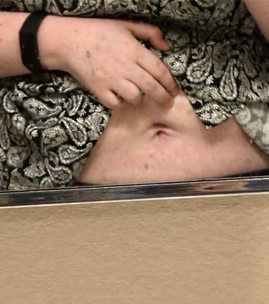 Surgery incision developed an abscess and now I have two bellybuttons