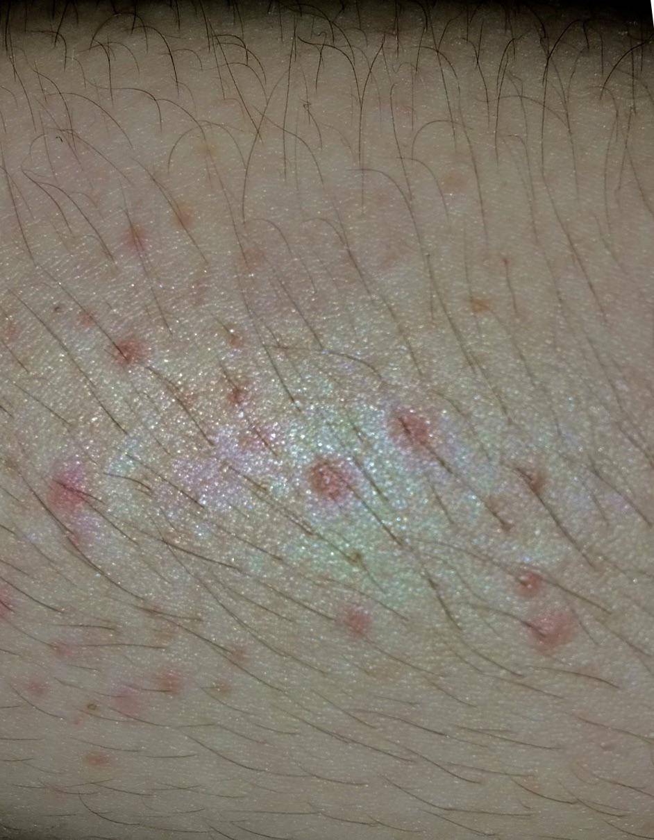 (21, F) really bad red rash all over arms, legs, and chest - doesn’t ...