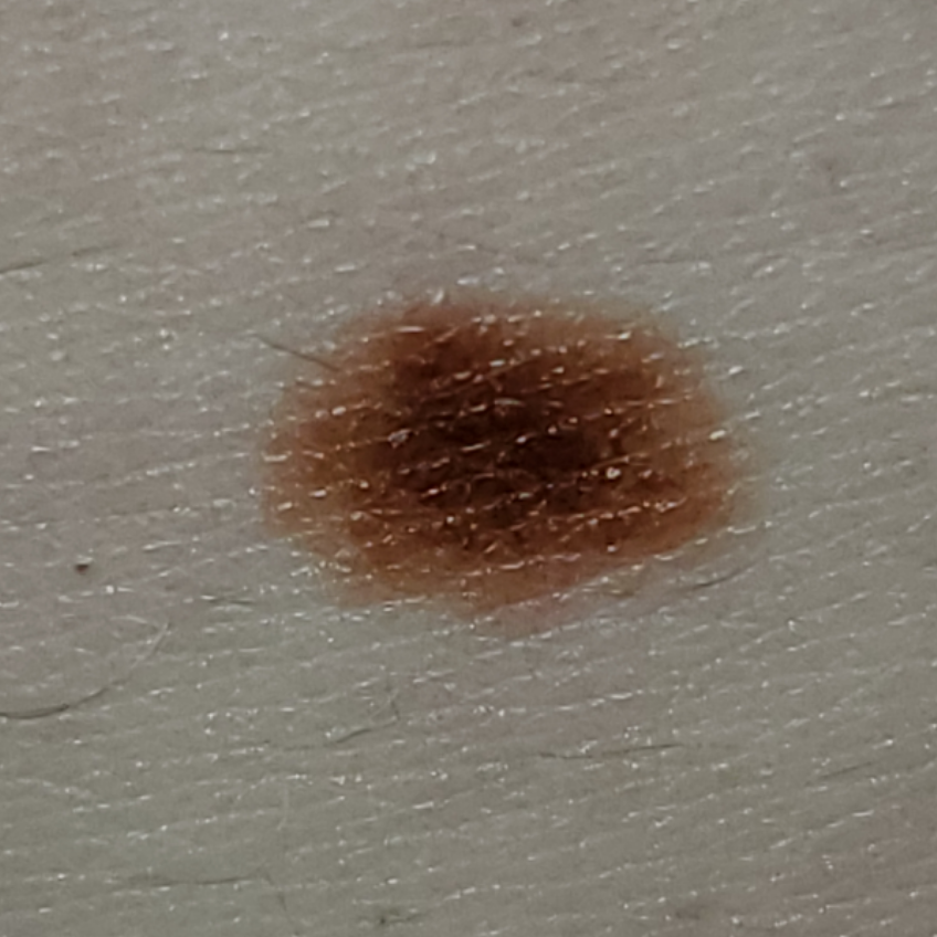 28... mole on belly. Showed up gradually with some other moles, ~3 yrs ...