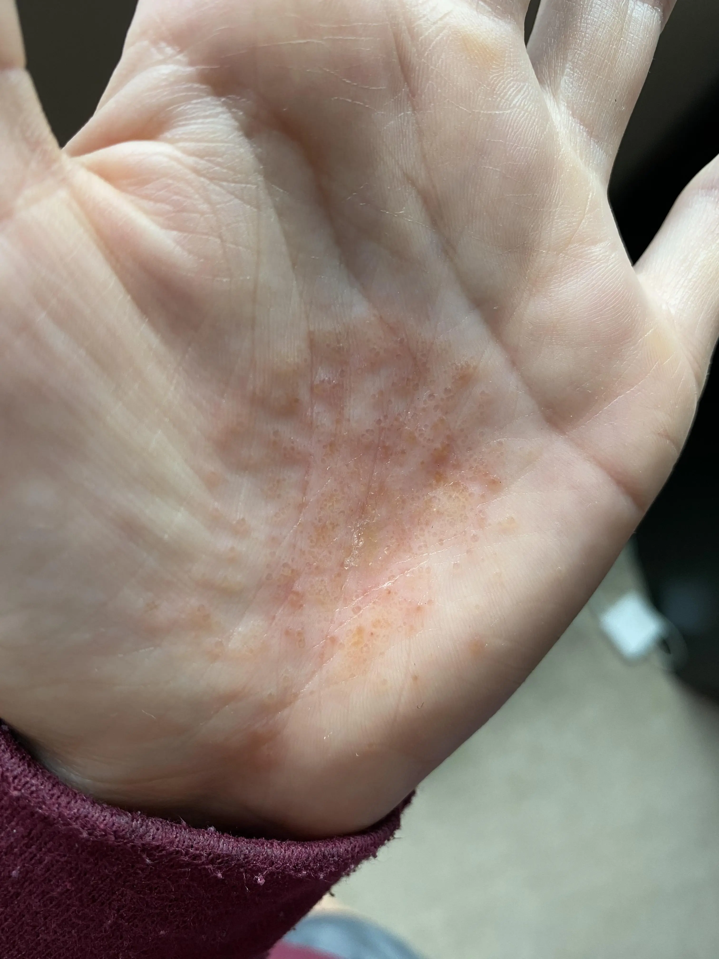 3 weeks in. Still expanding. Hand/finger tips is warmer than other non ...