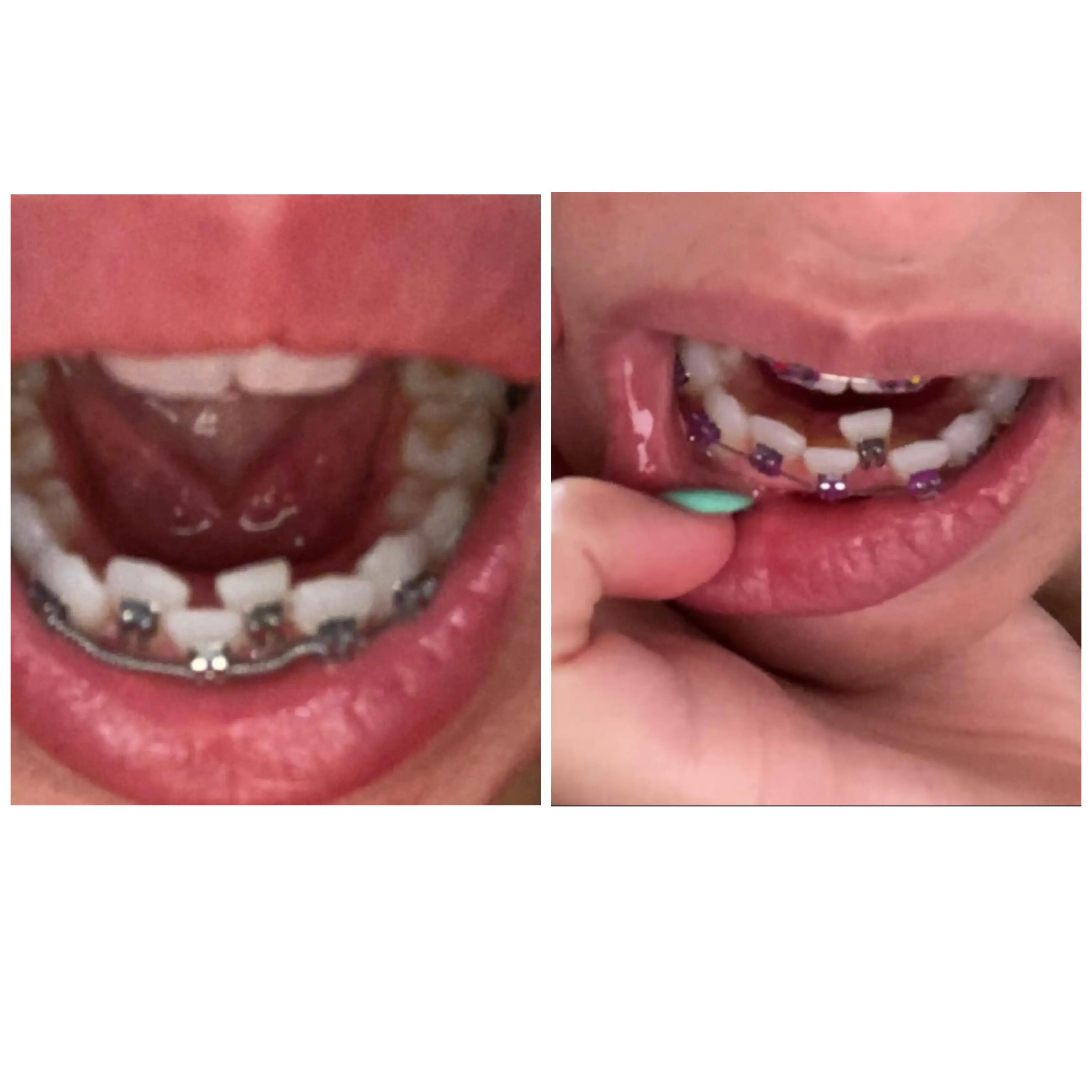 8 week progress. Opened space on left side, now bringing tooth in. Next ...