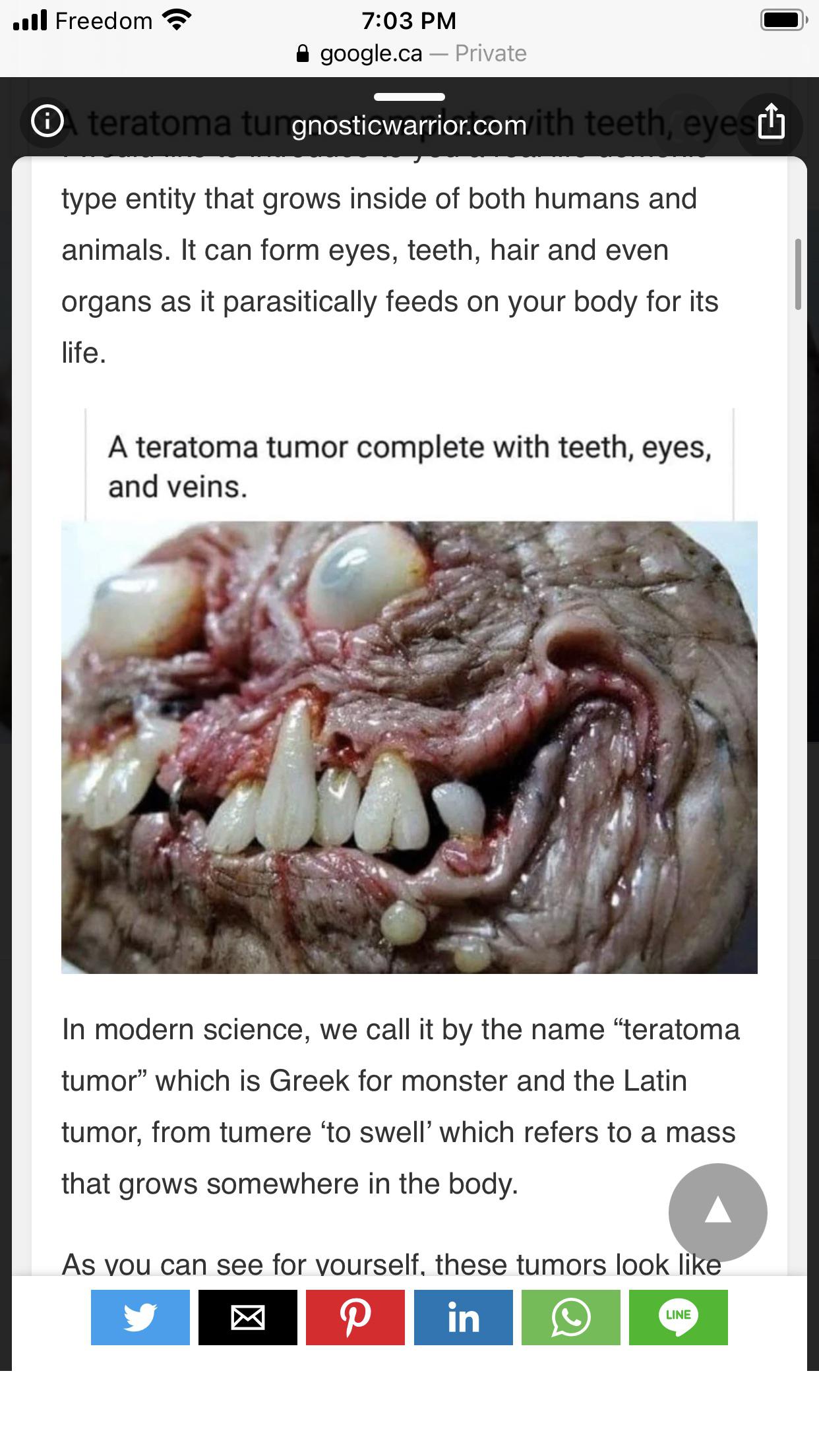 A Teratoma Tumor Complete With Teeth Eyes And Veins Scrolller