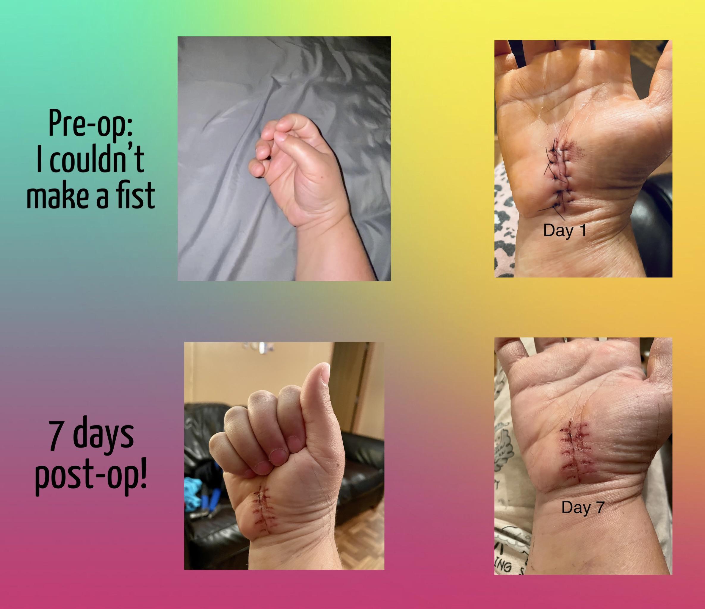 Carpal tunnel the miracles of modern medicine! Scrolller