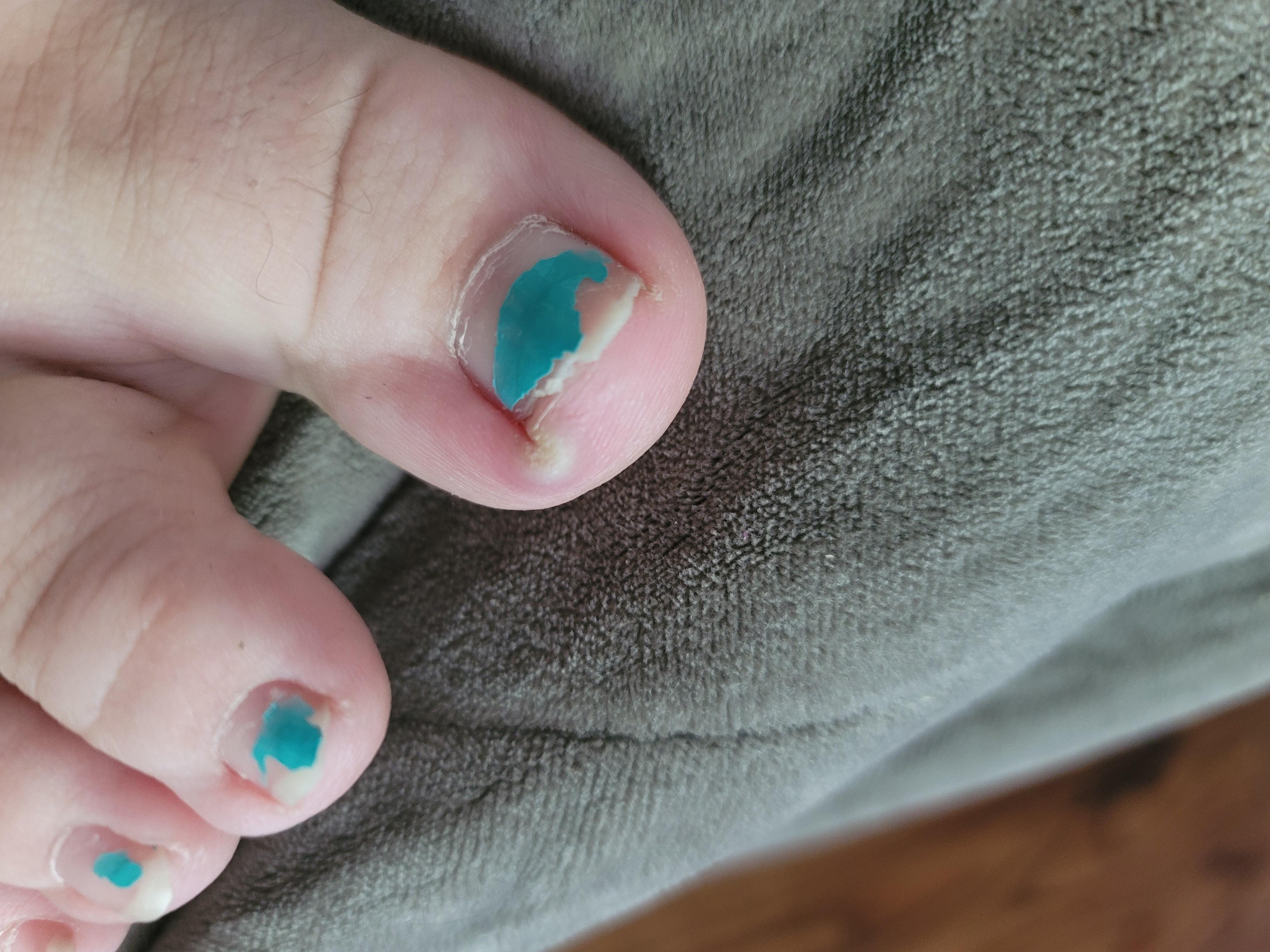 cut-out-an-ingrown-toenail-and-this-bad-boy-popped-up-after-a-week-of