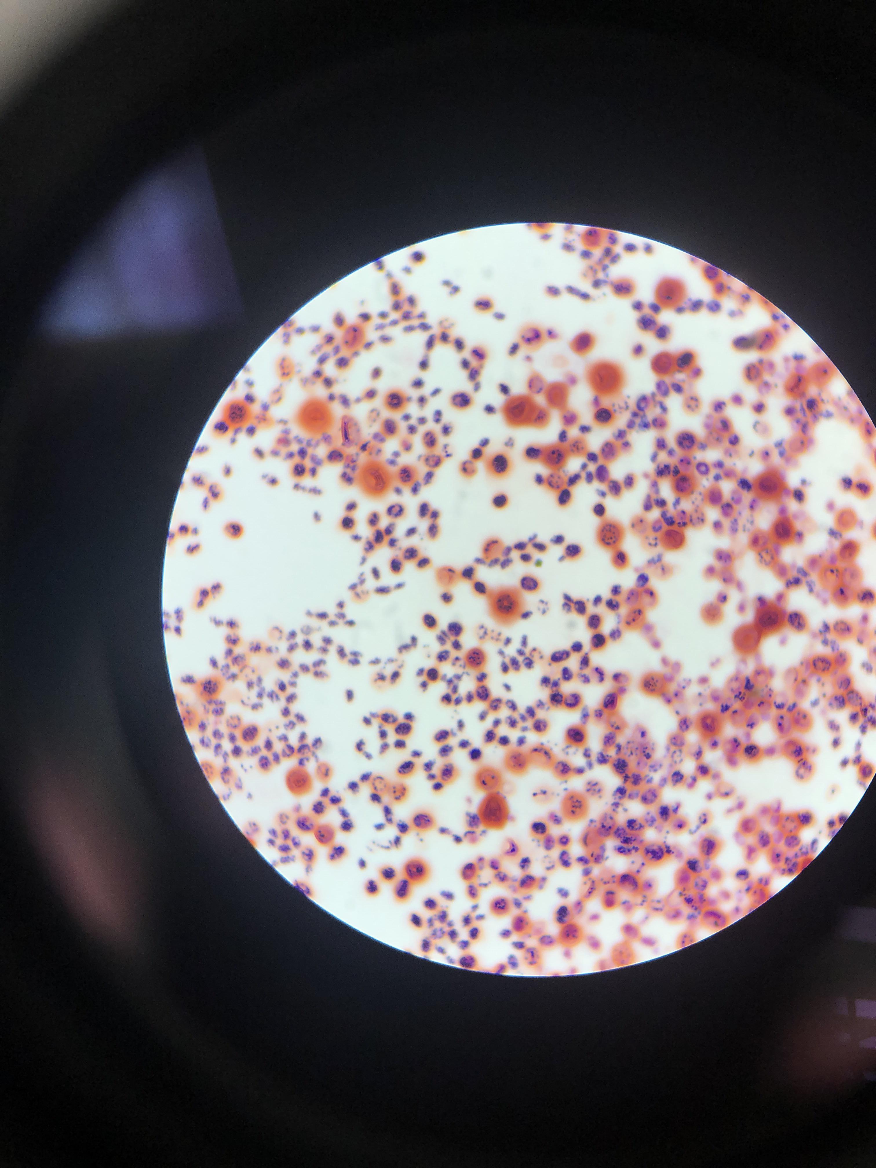 Gram Stain of CSF filled with Cryptococcus neoformans | Scrolller