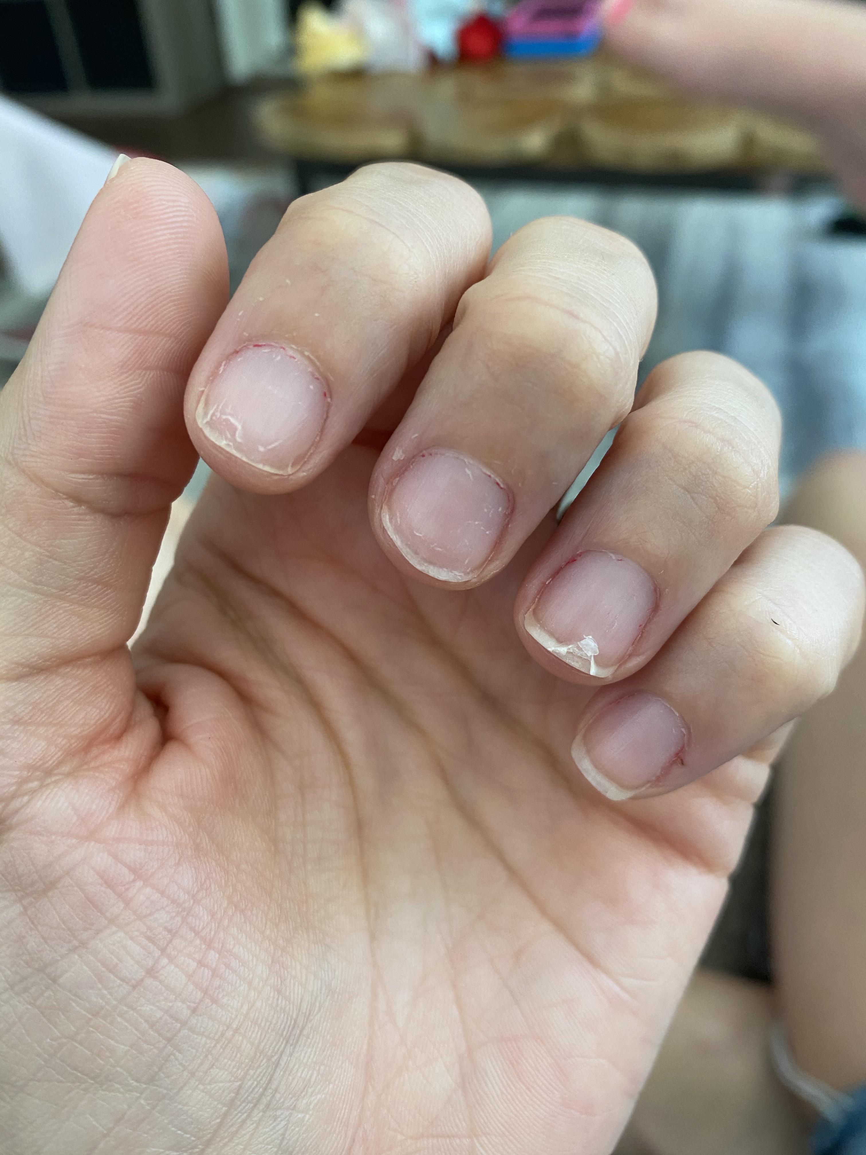 why-are-my-nails-peeling-allure