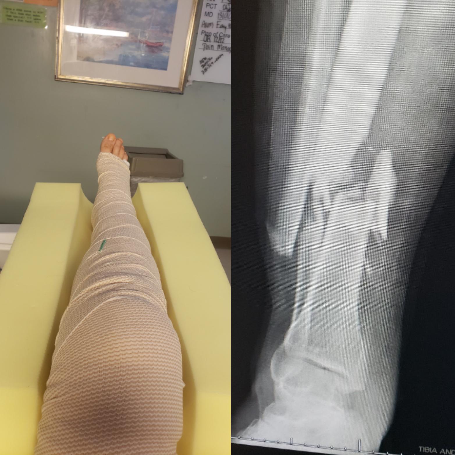 Tibia Hit Hit by a car. RRP tibia and fibula. | Scrolller