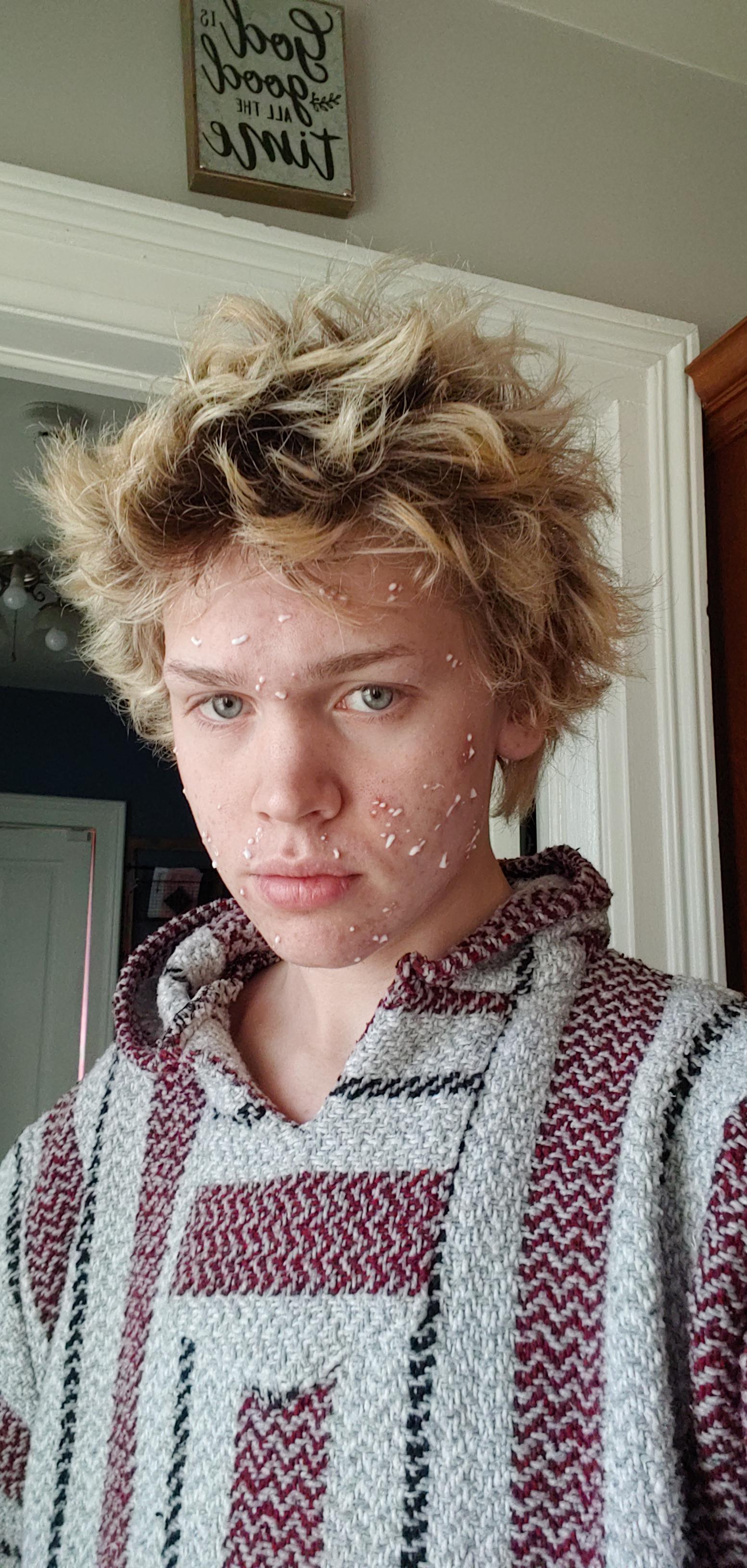 it-s-okay-to-have-acne-kids-scrolller