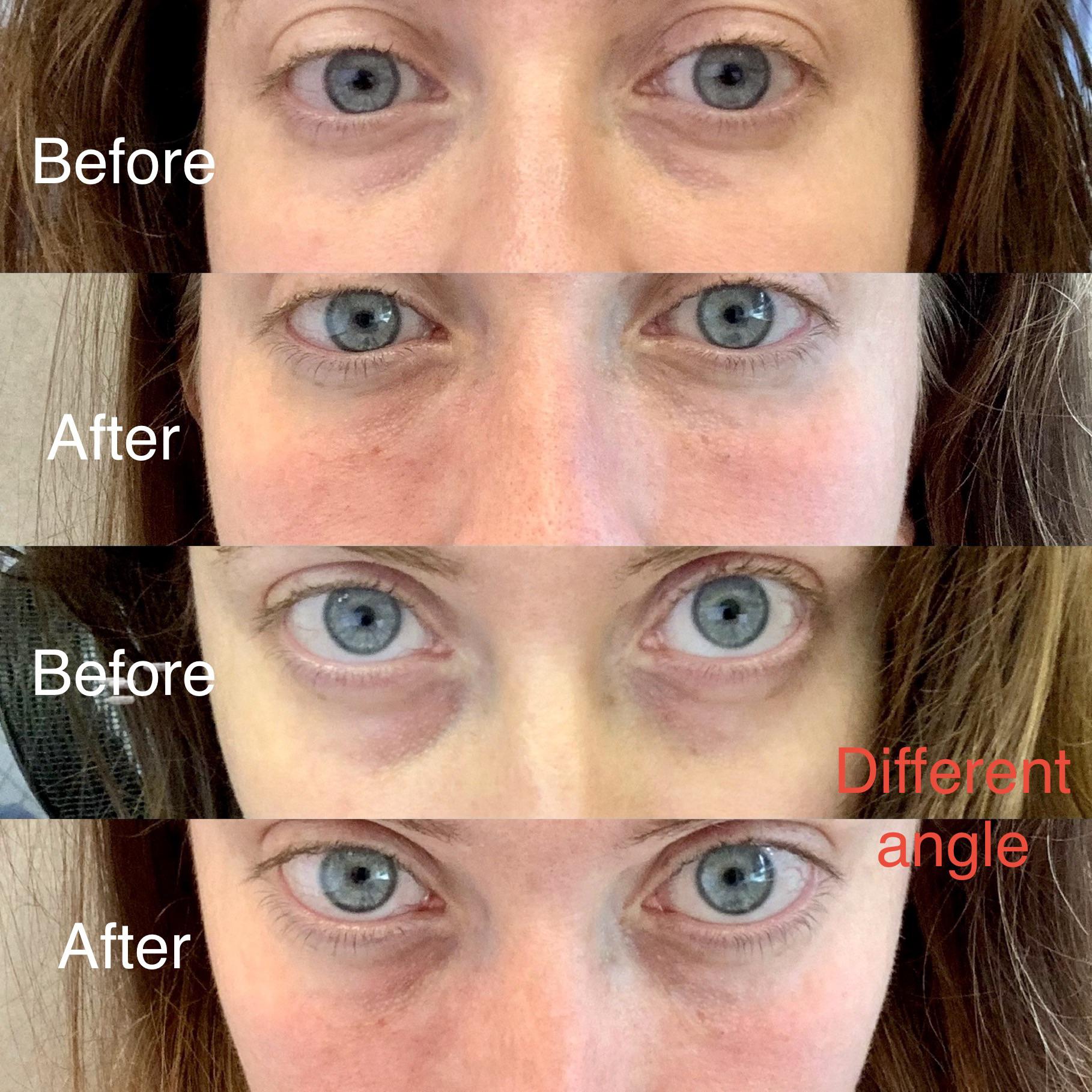 my-tear-trough-restylane-results-scrolller