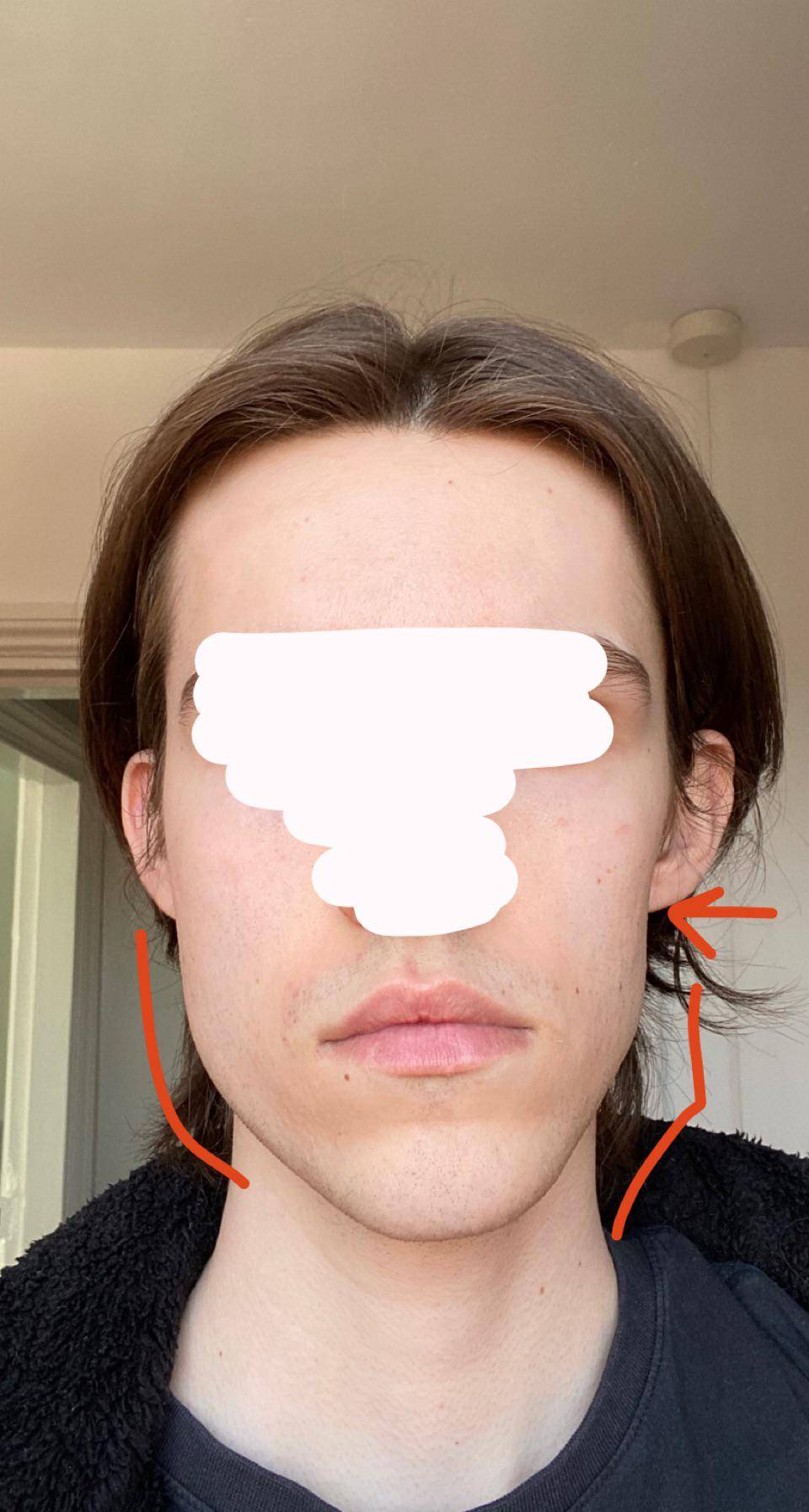 Need some advice on fixing my uneven skewed jaw Scrolller