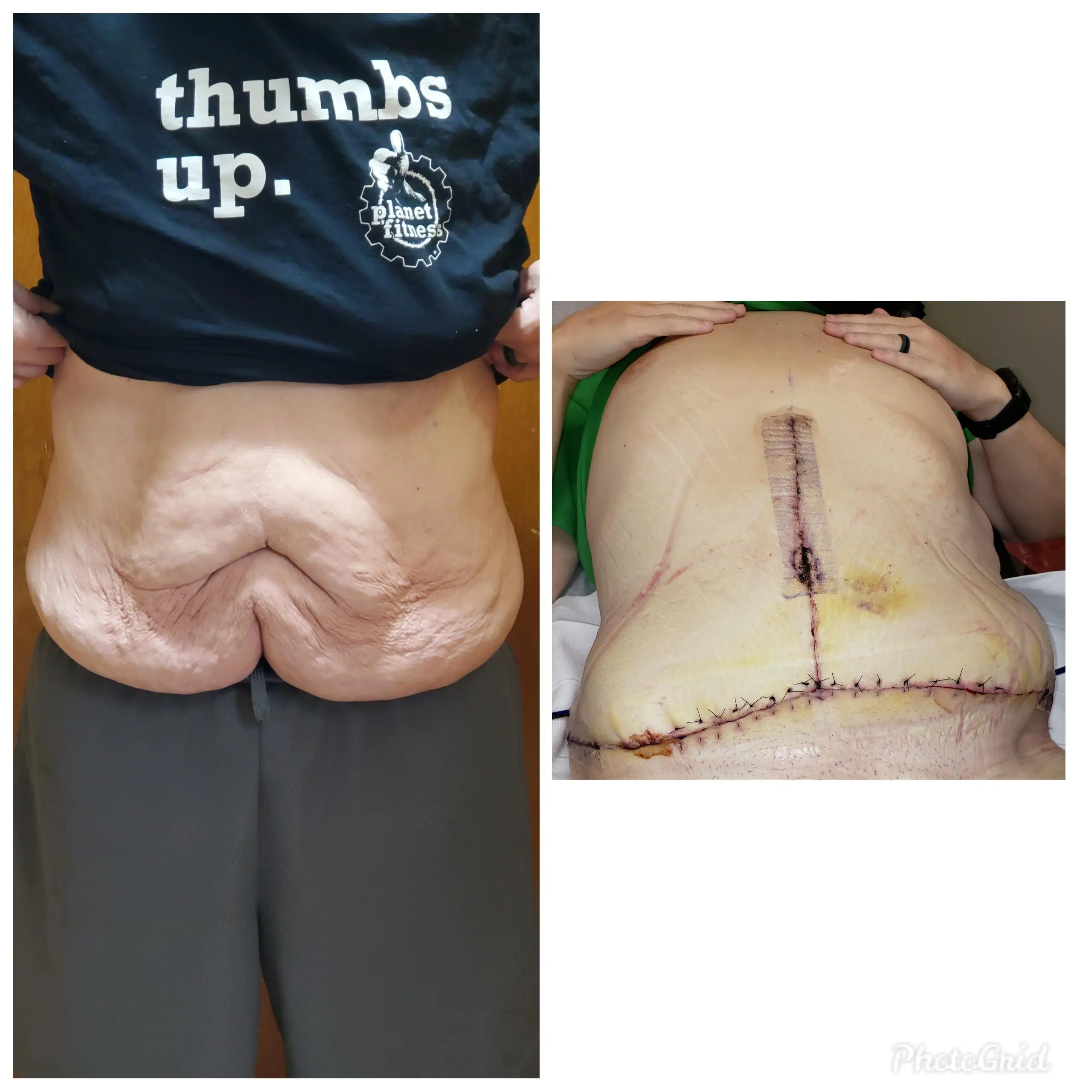 Panniculectomy 1 week update. I have a waistline!