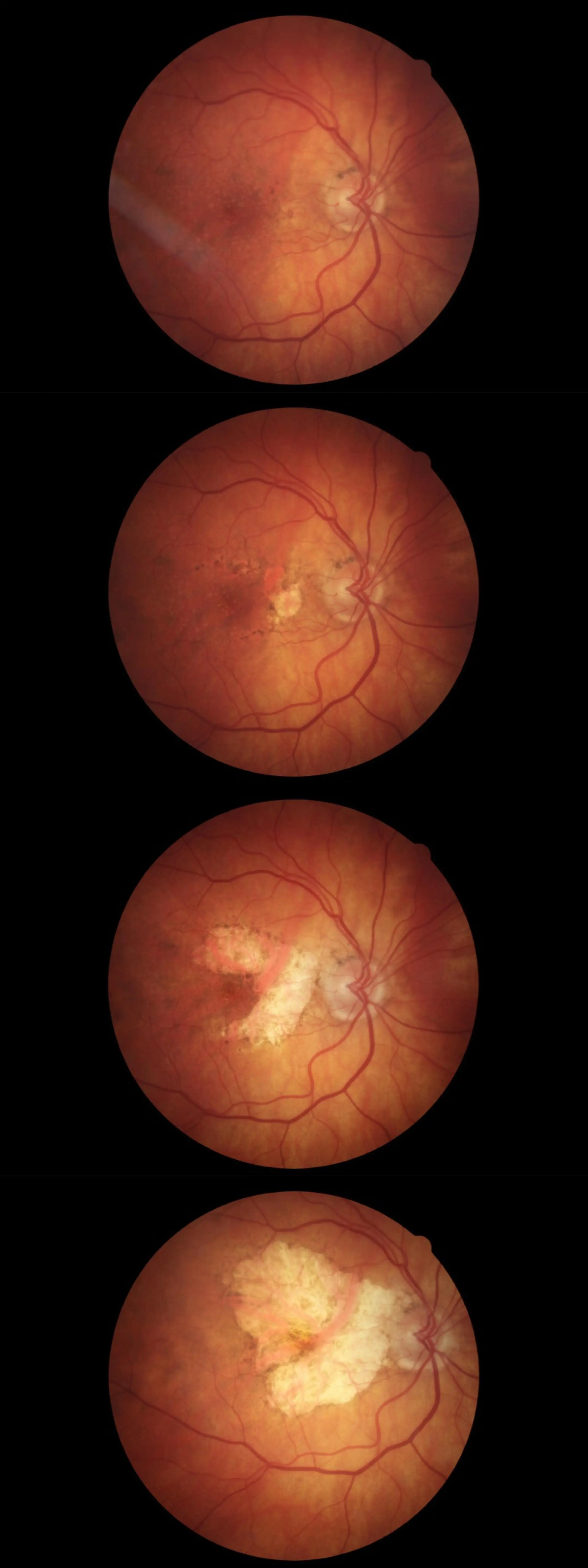 Progression of geographic atrophy over a 10 year period | Scrolller