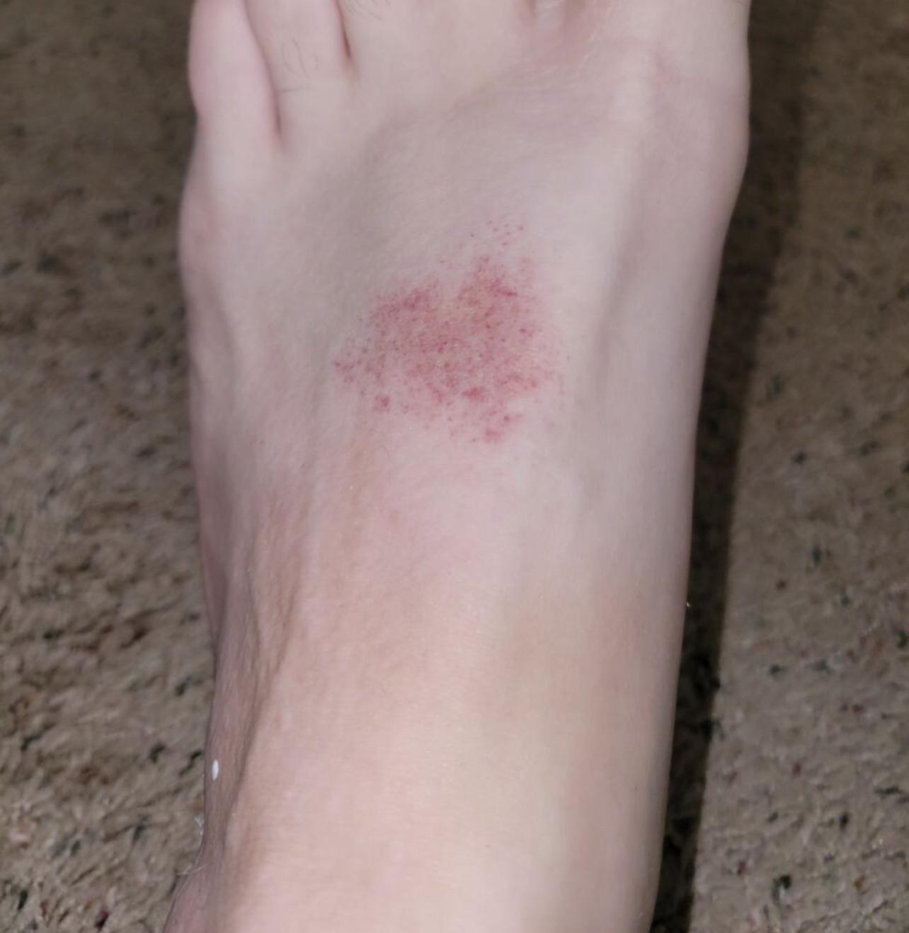 Rash on foot, ideas? | Scrolller