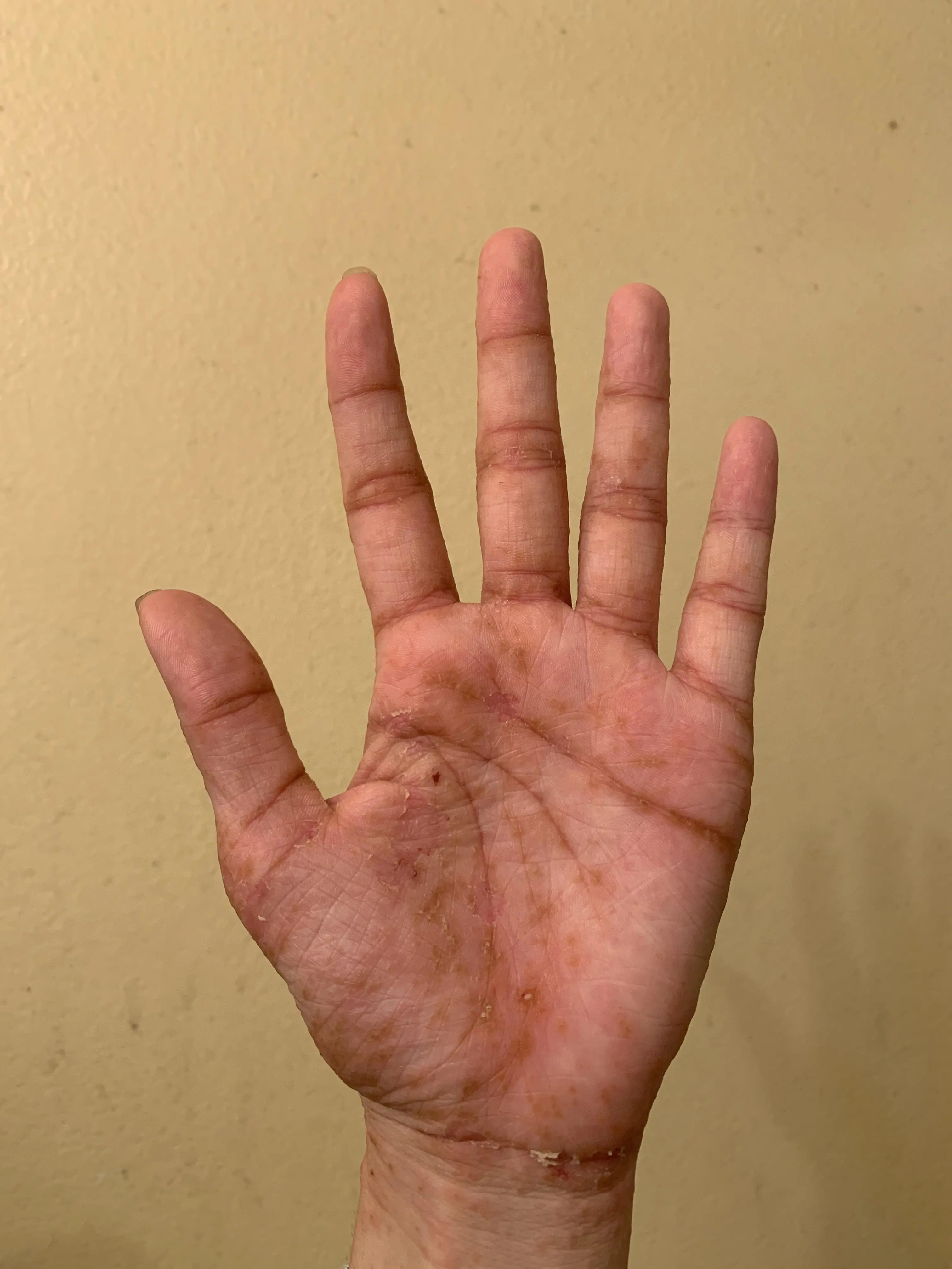 Crusty Blusters So the blisters stopped developing but the old ones got all crusty, do ...