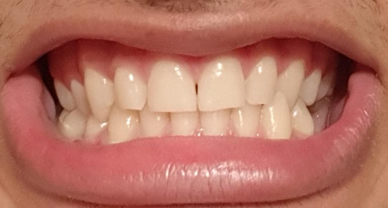 teeth sit on top of each other