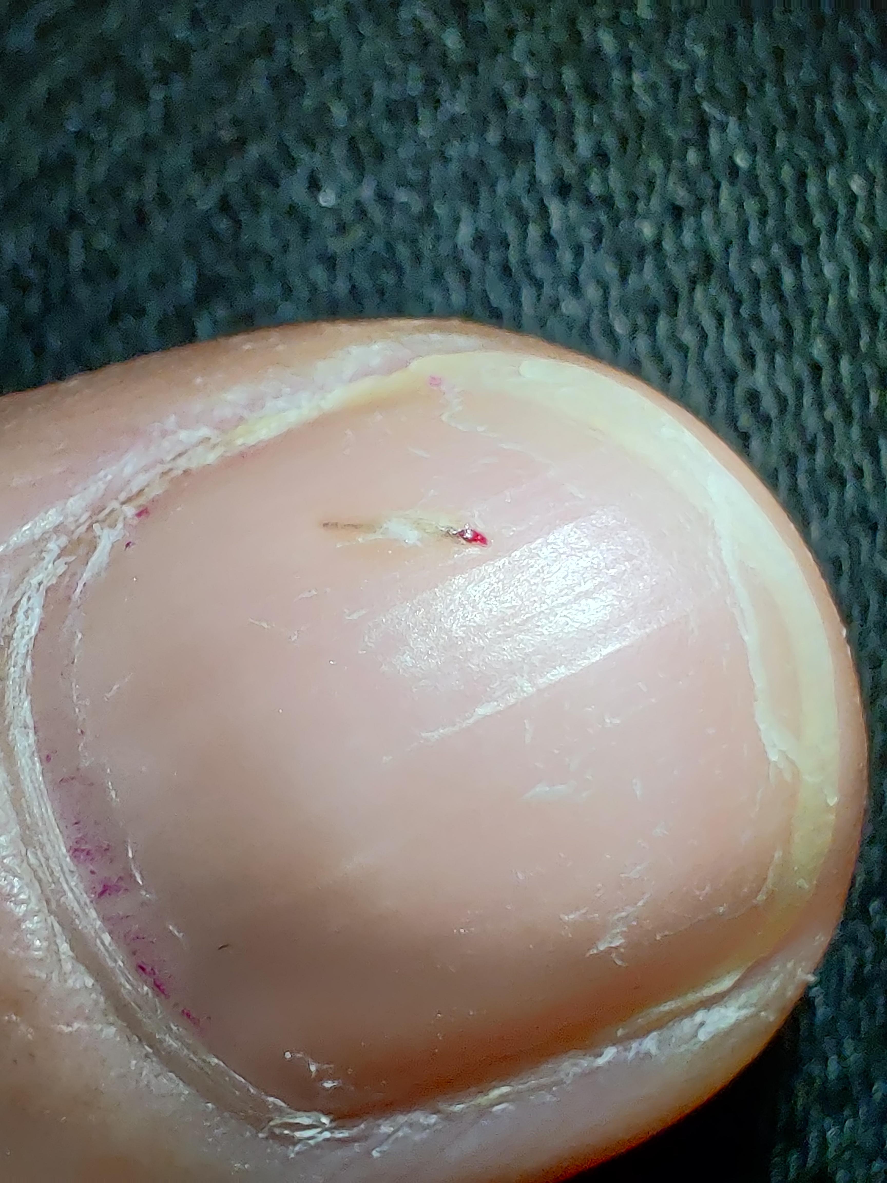 Unexplained splinter under fingernail. Unable to extract! Wth could it