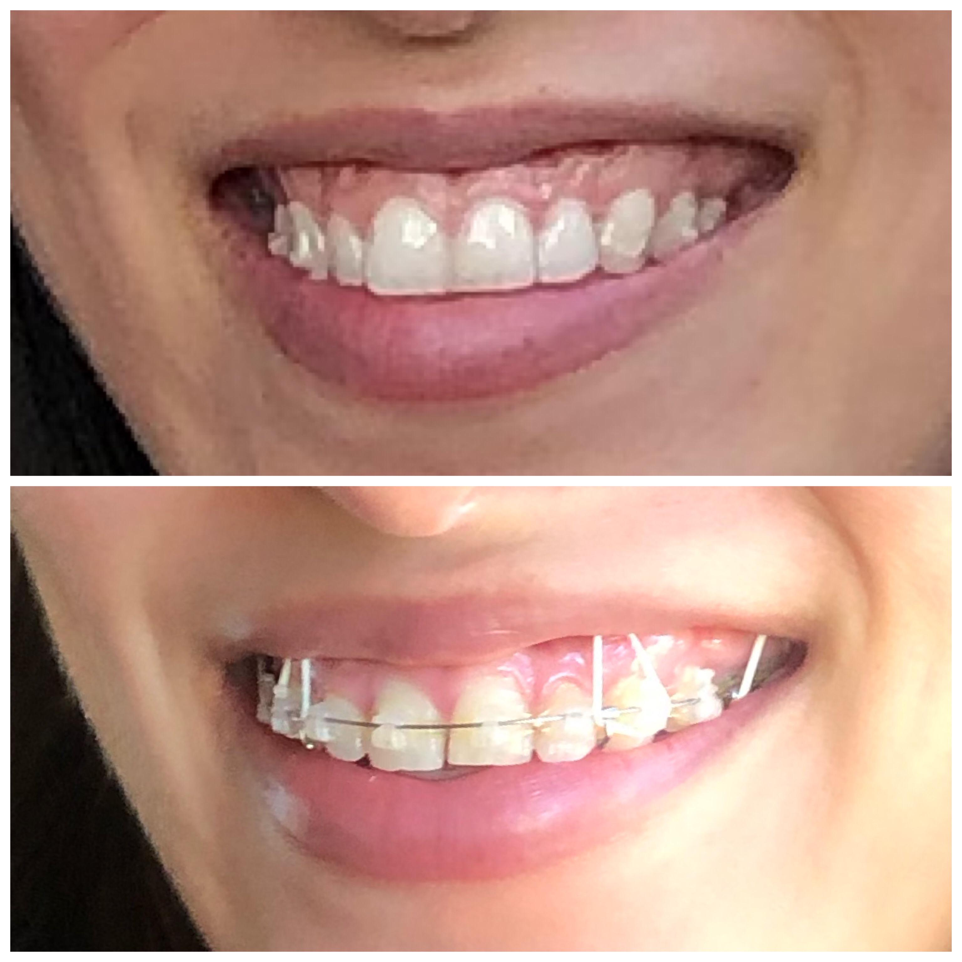 Brief switch to braces+tads+elastics to fix my gummy smile, then back