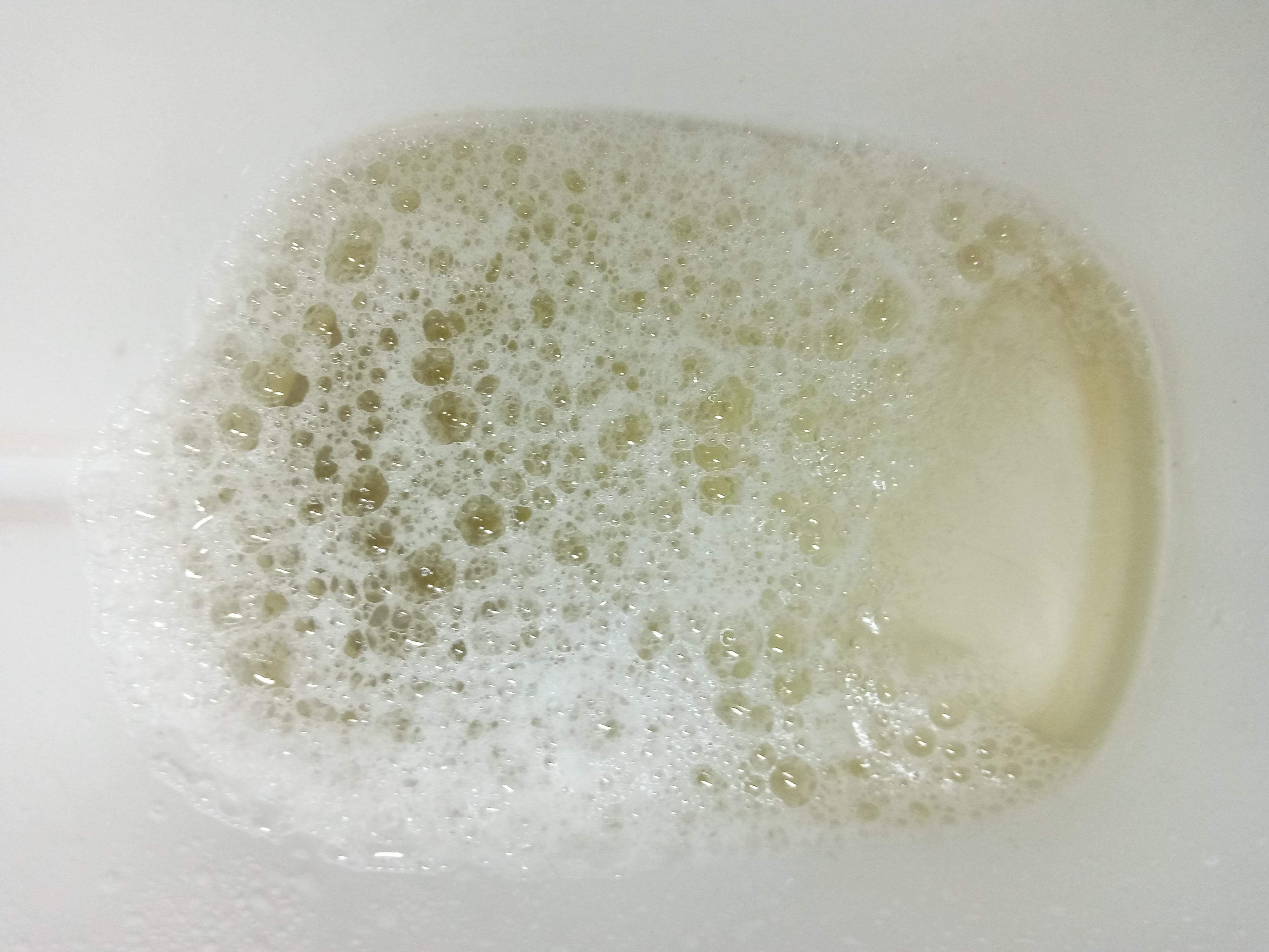 Foamy Urine Urinalysis Comes With No Protein What Is The Cause 