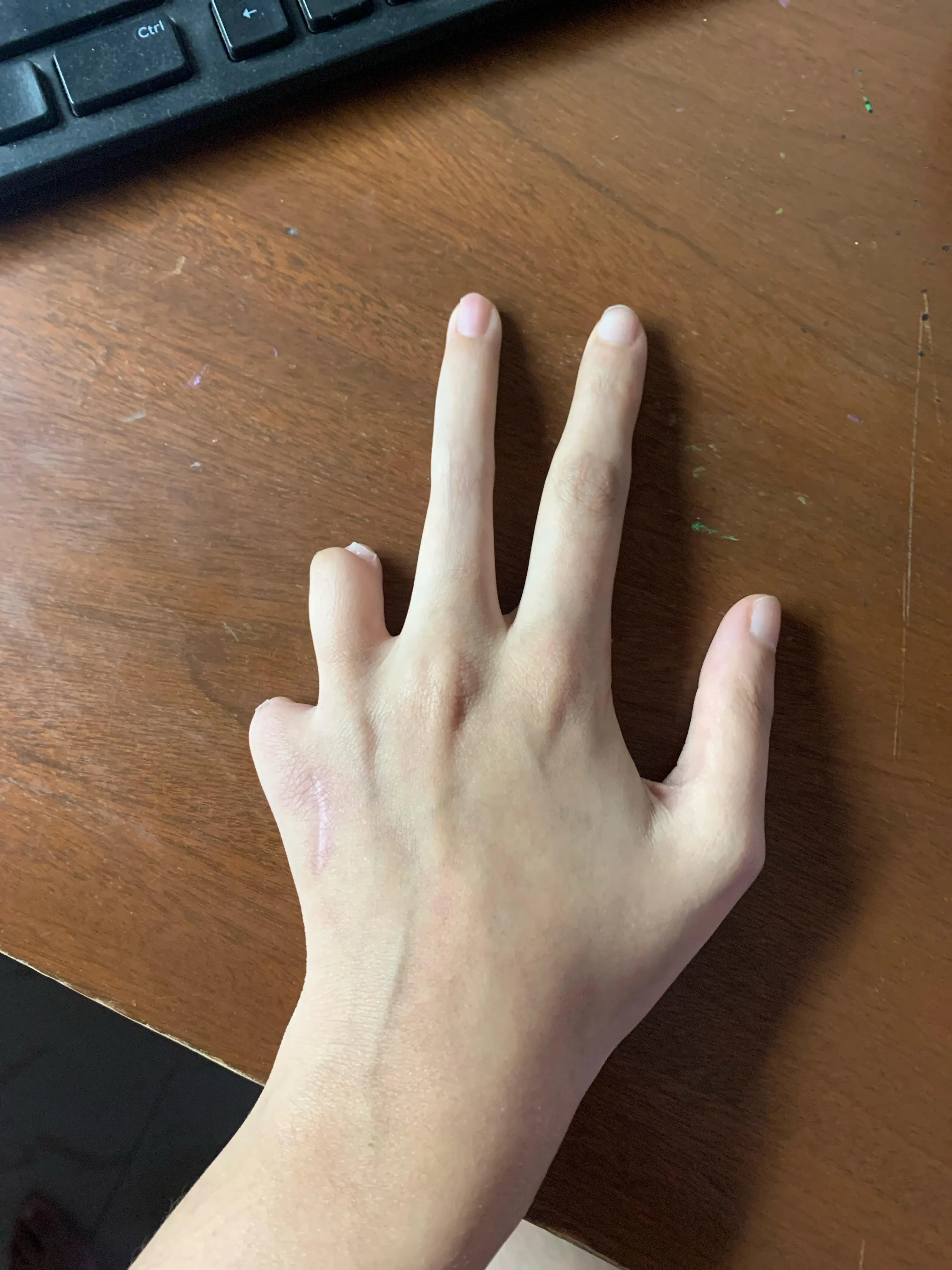 My left hand after a shower | Scrolller