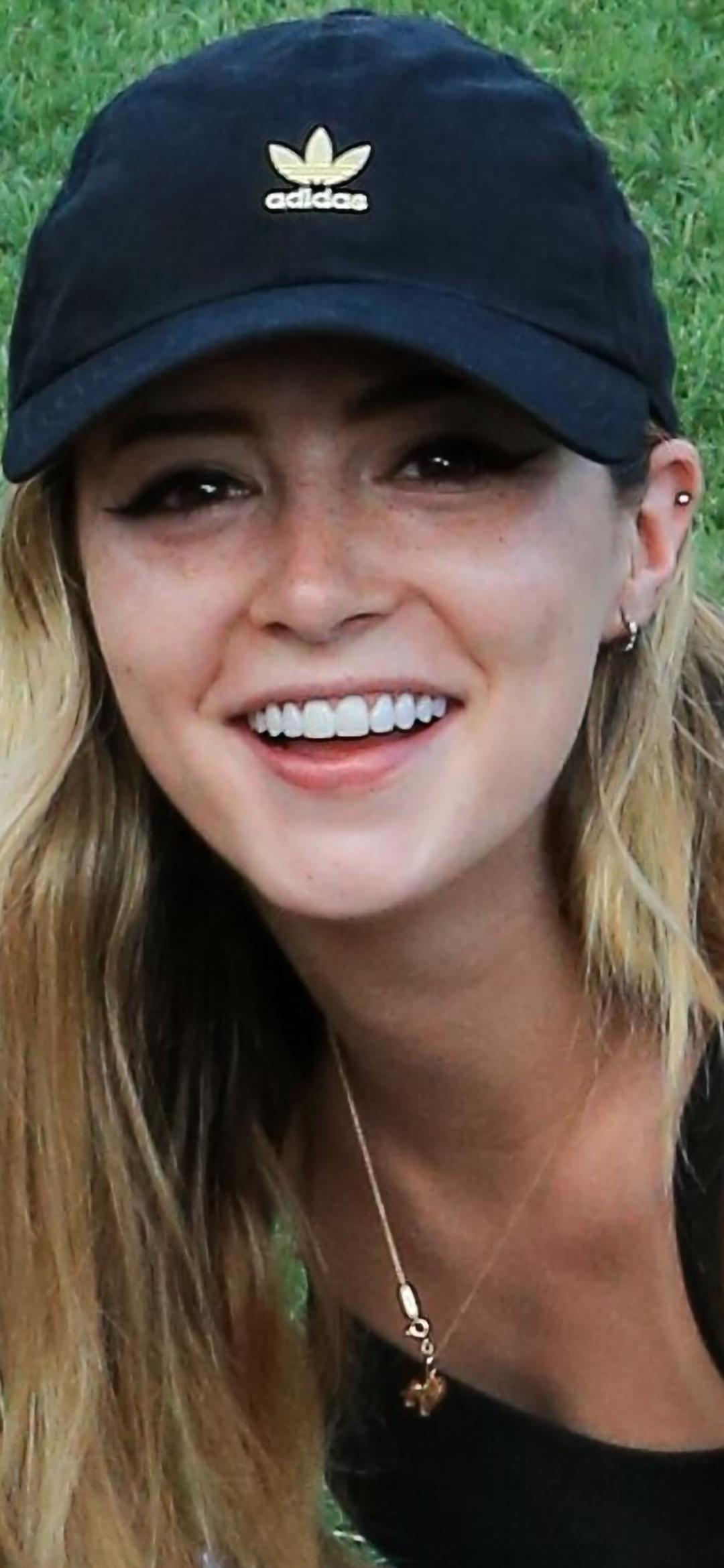 When did she get veneers and why? Scrolller