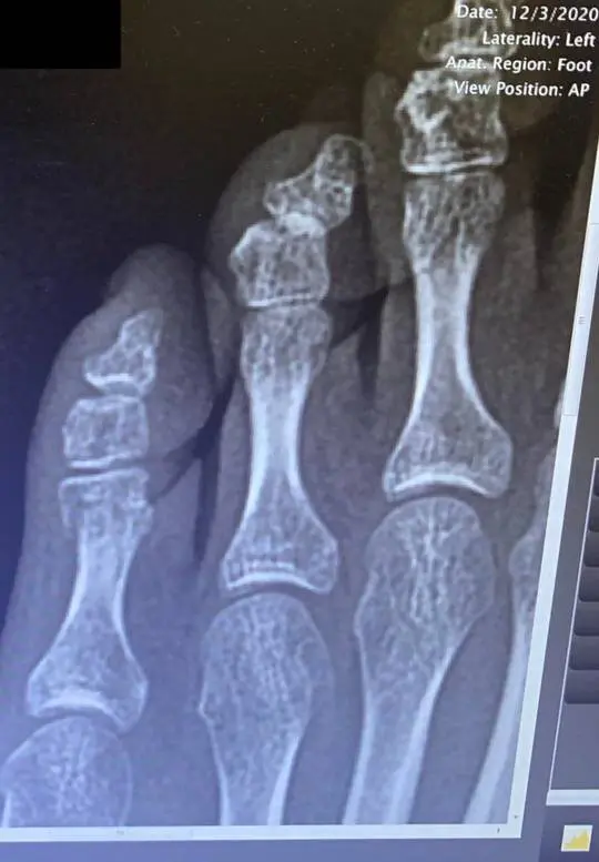11 weeks in, pinky toe shows no signs of healing. Doctor says in one ...