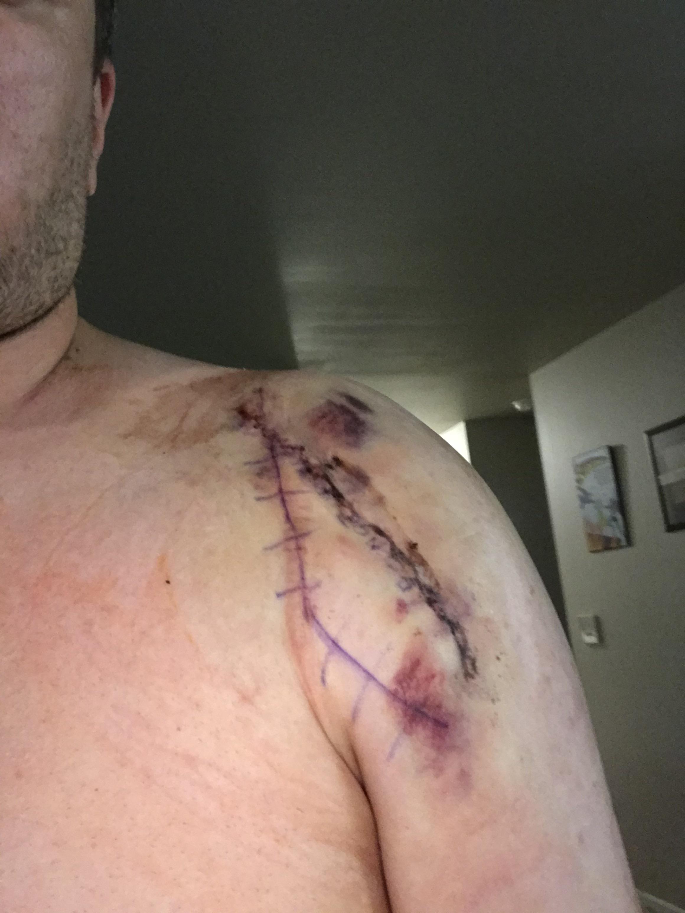 2 days post op. Total reverse shoulder replacement. Nerve block is