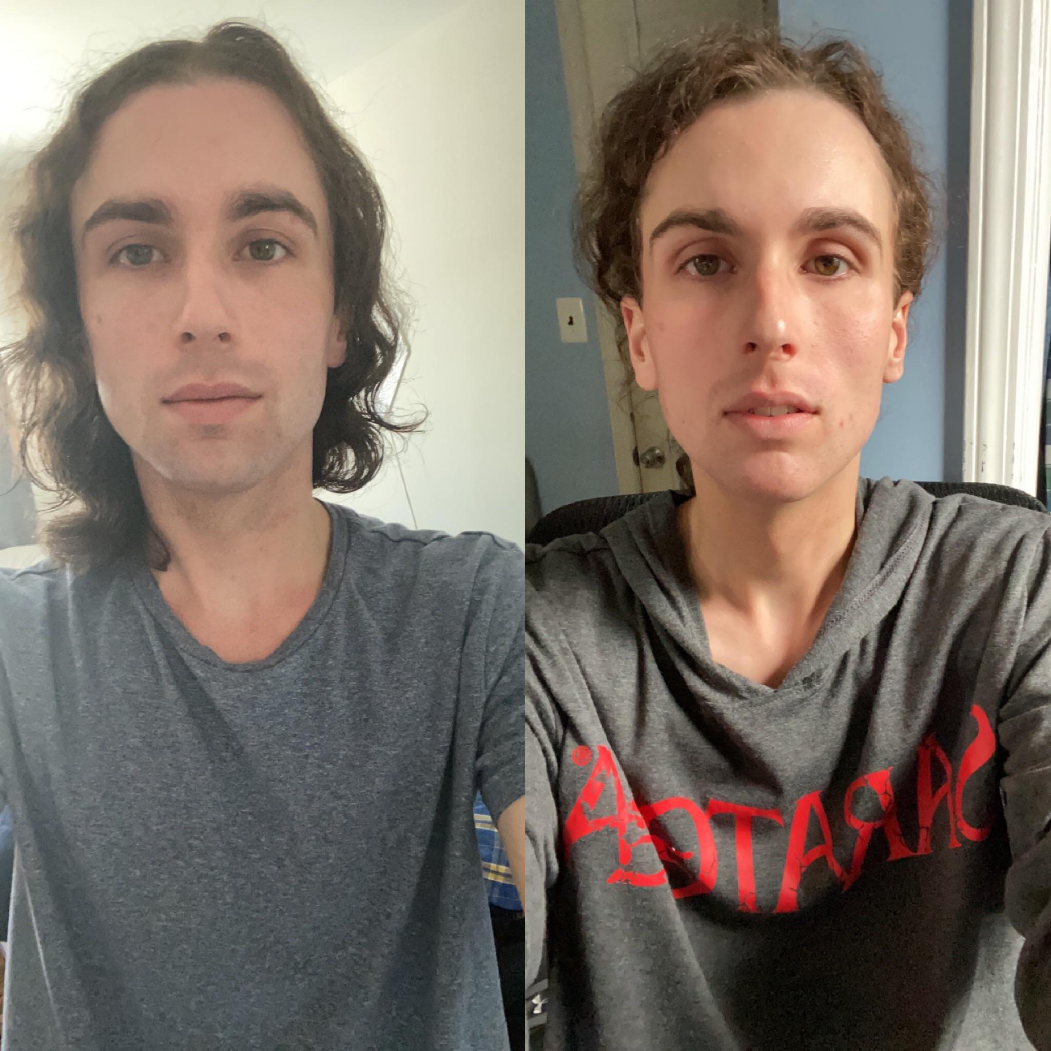 2 Months Hrt Vs 8 Months Mtf Scrolller 