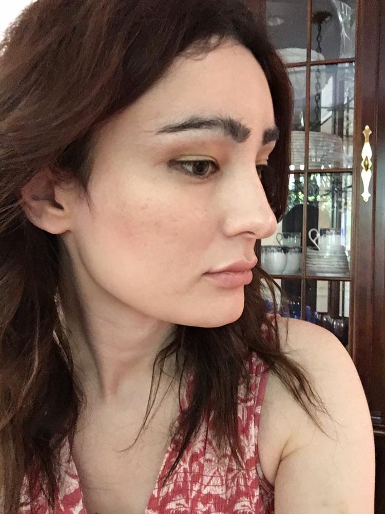 6 months post-FFS with Dr. Rolfes! | Scrolller