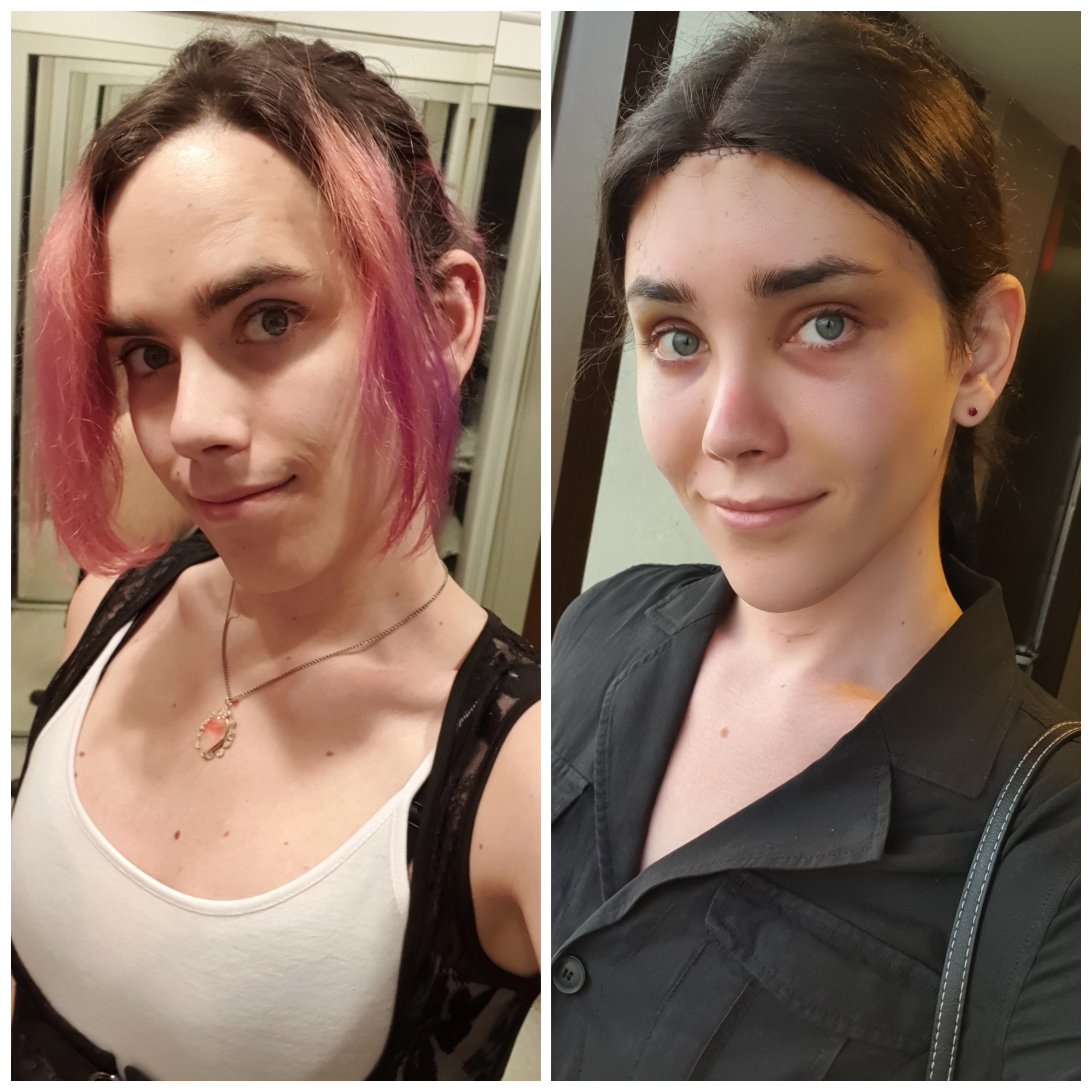 A simpler timeline, before vs after FFS (4 days post-op, age 28 ...