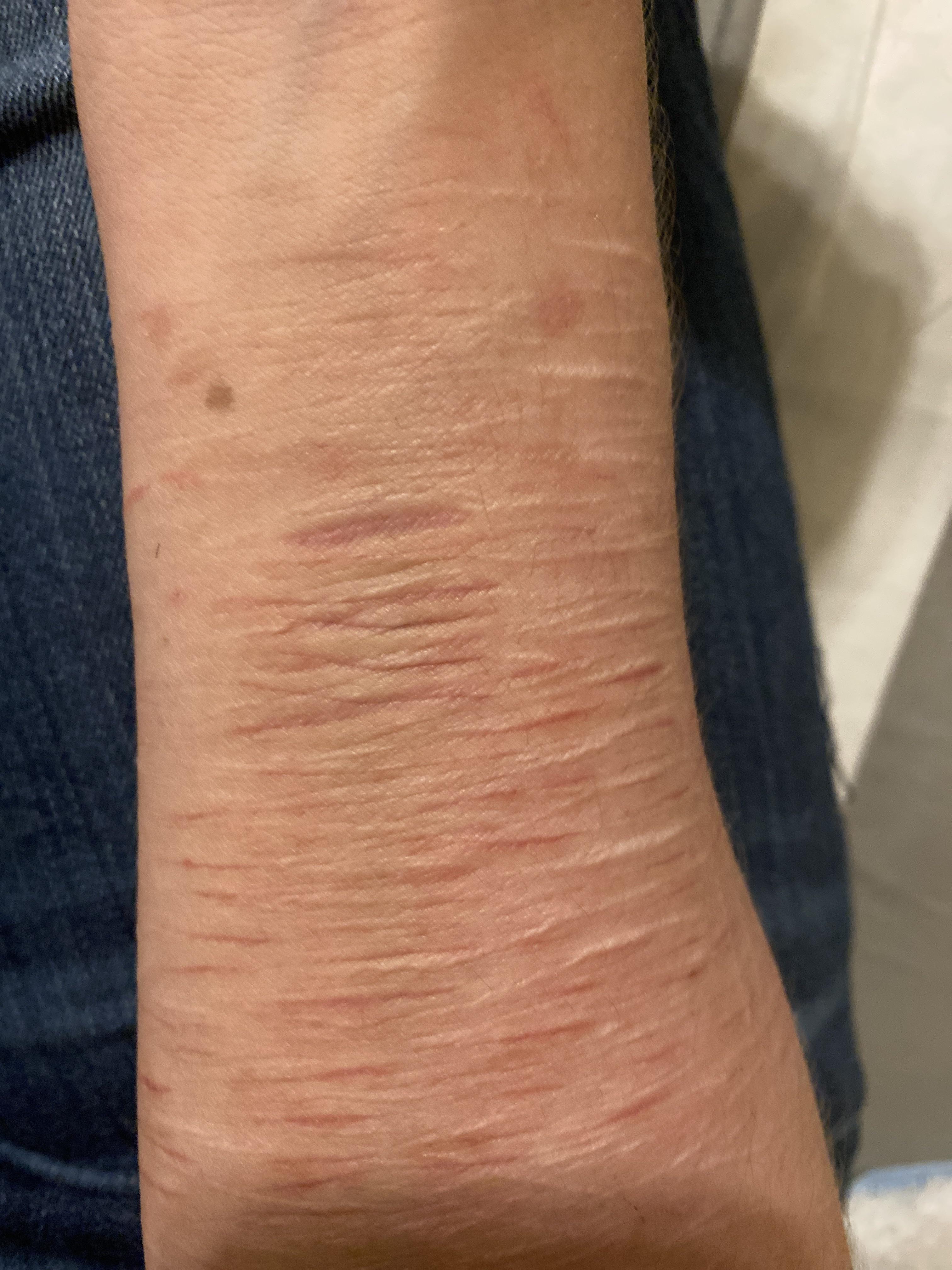 Any advice on getting the big one to fade faster? It’s almost 4 months ...