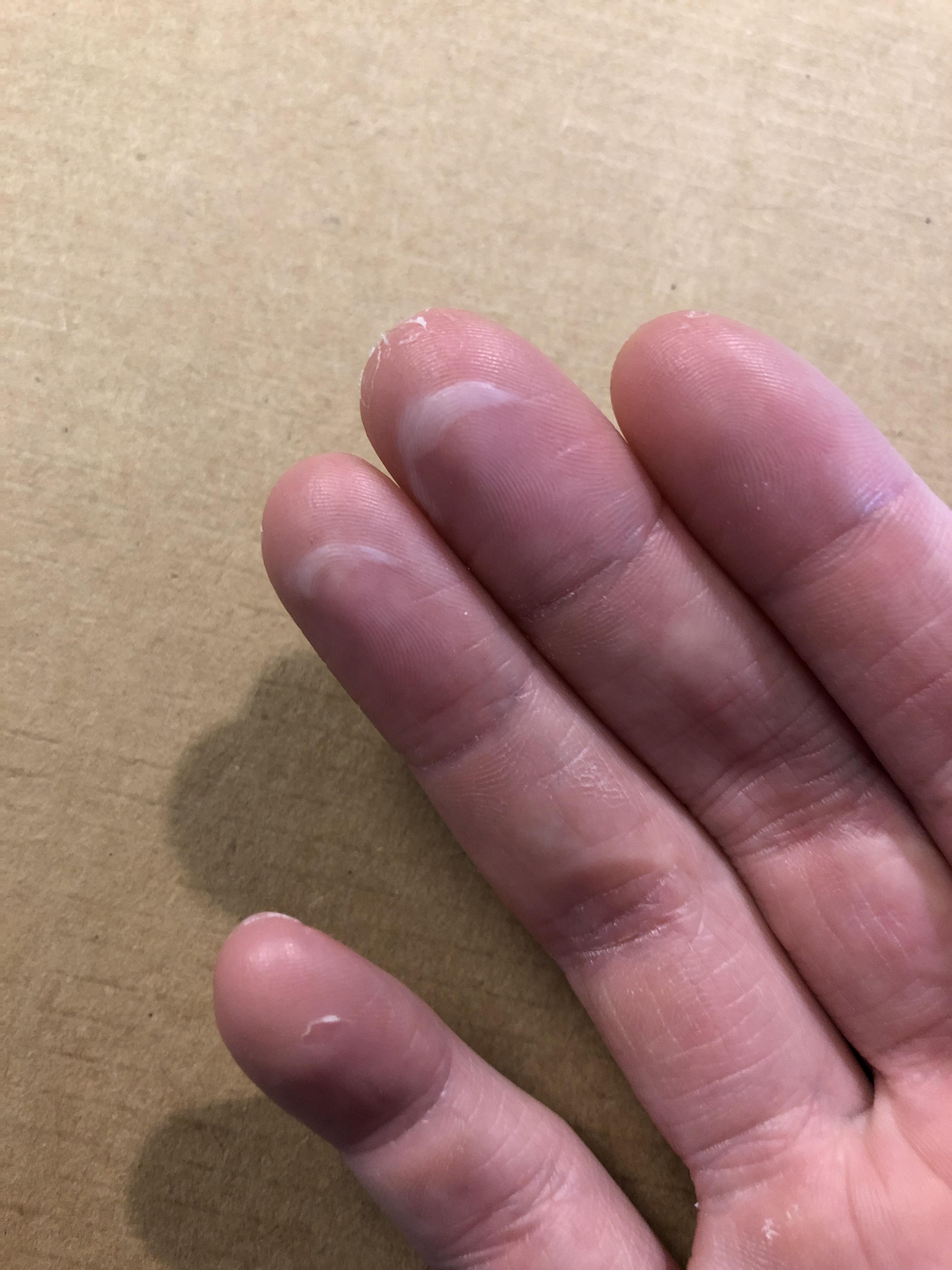 Any tips for climbing with the weirdest blisters on my finger tips