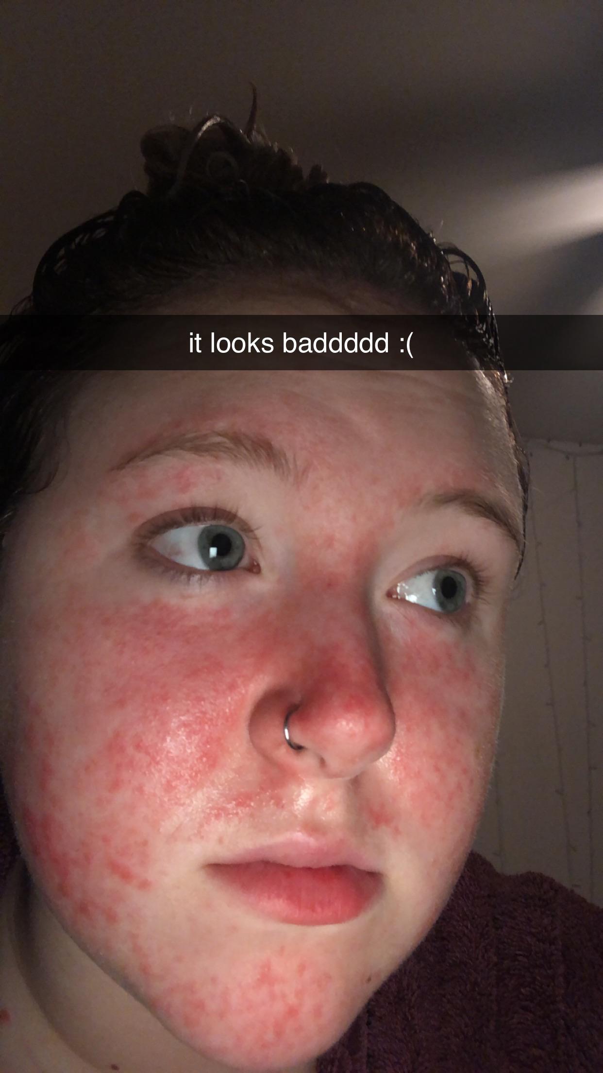 Been stuck with this rash for over 50 days! I’ve been on bactrim ...