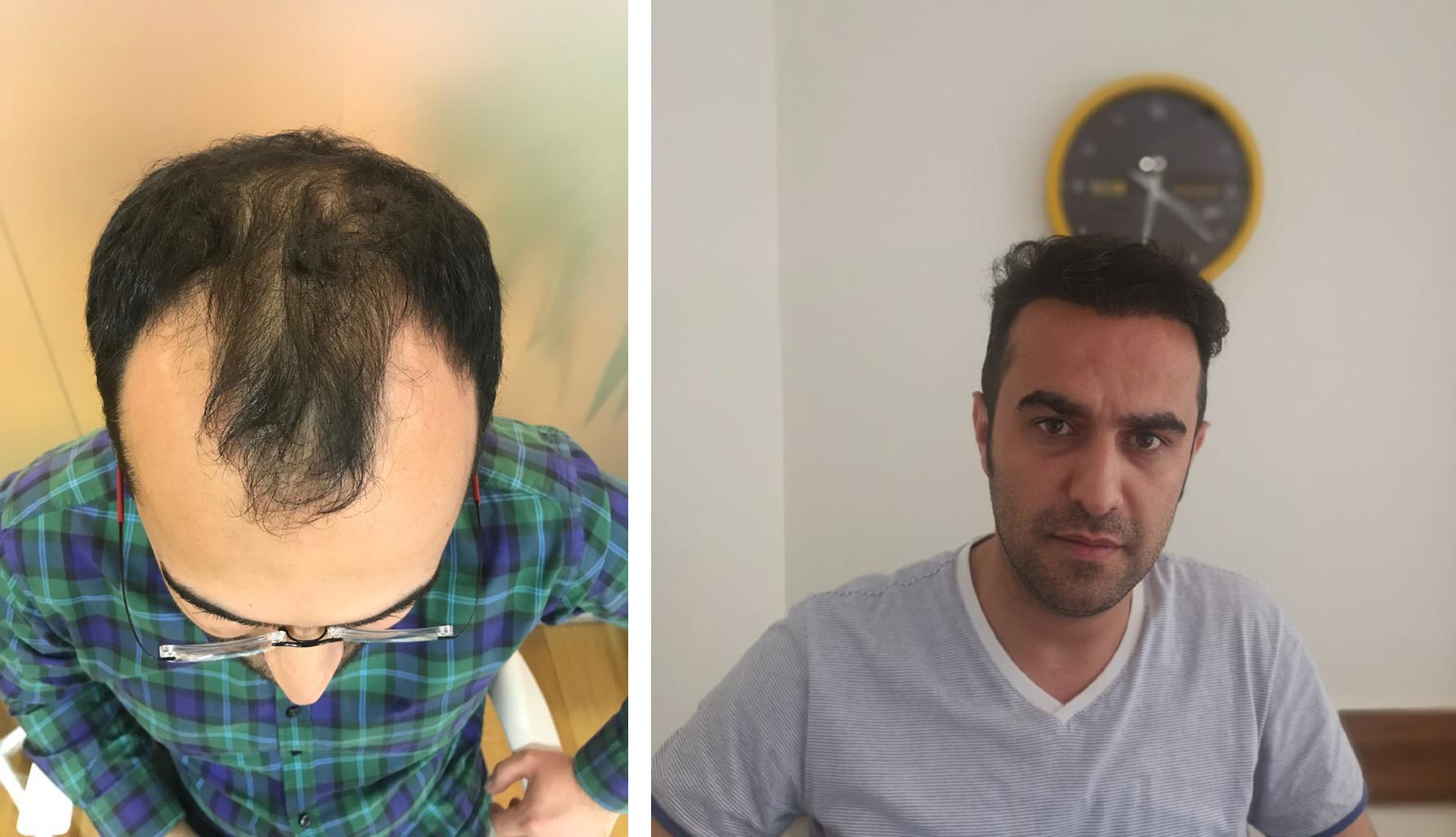 Before hair transplant and after 19 months update, no finasteride no