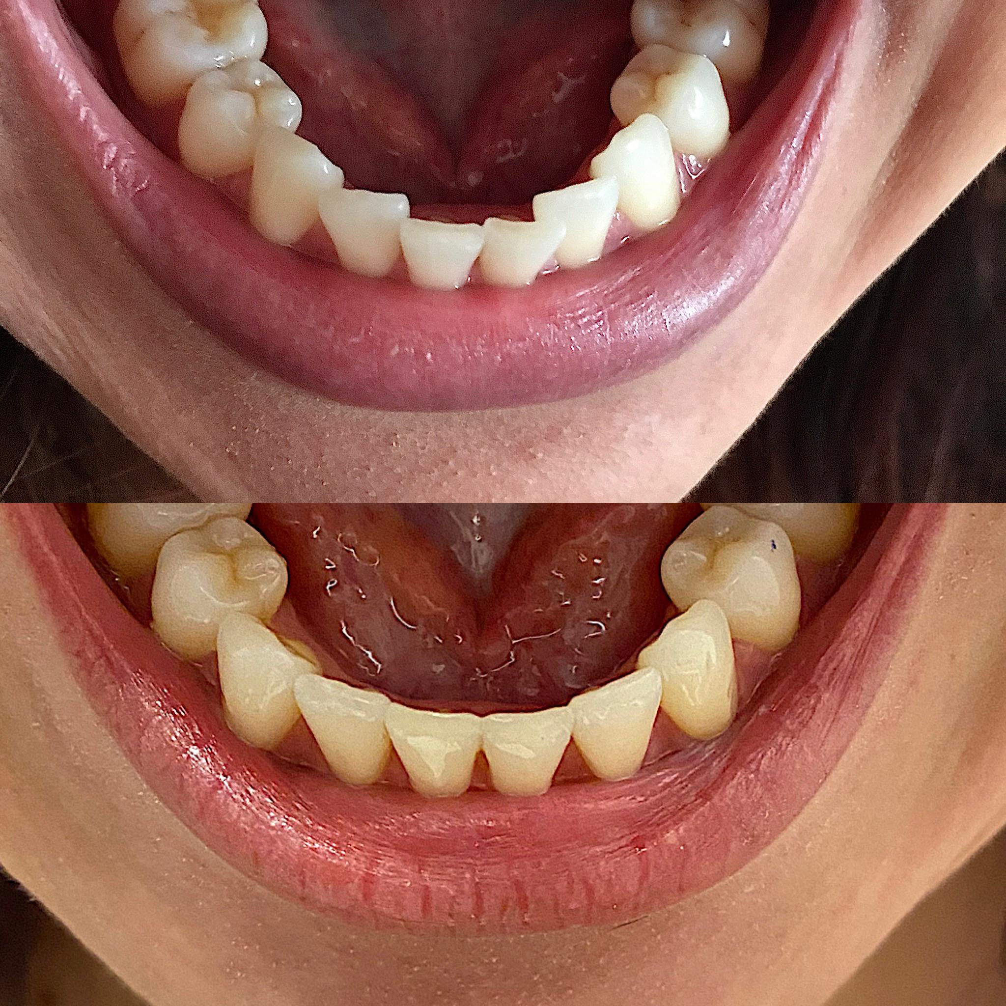 Bottom Tooth Bottom teeth before/after | Scrolller