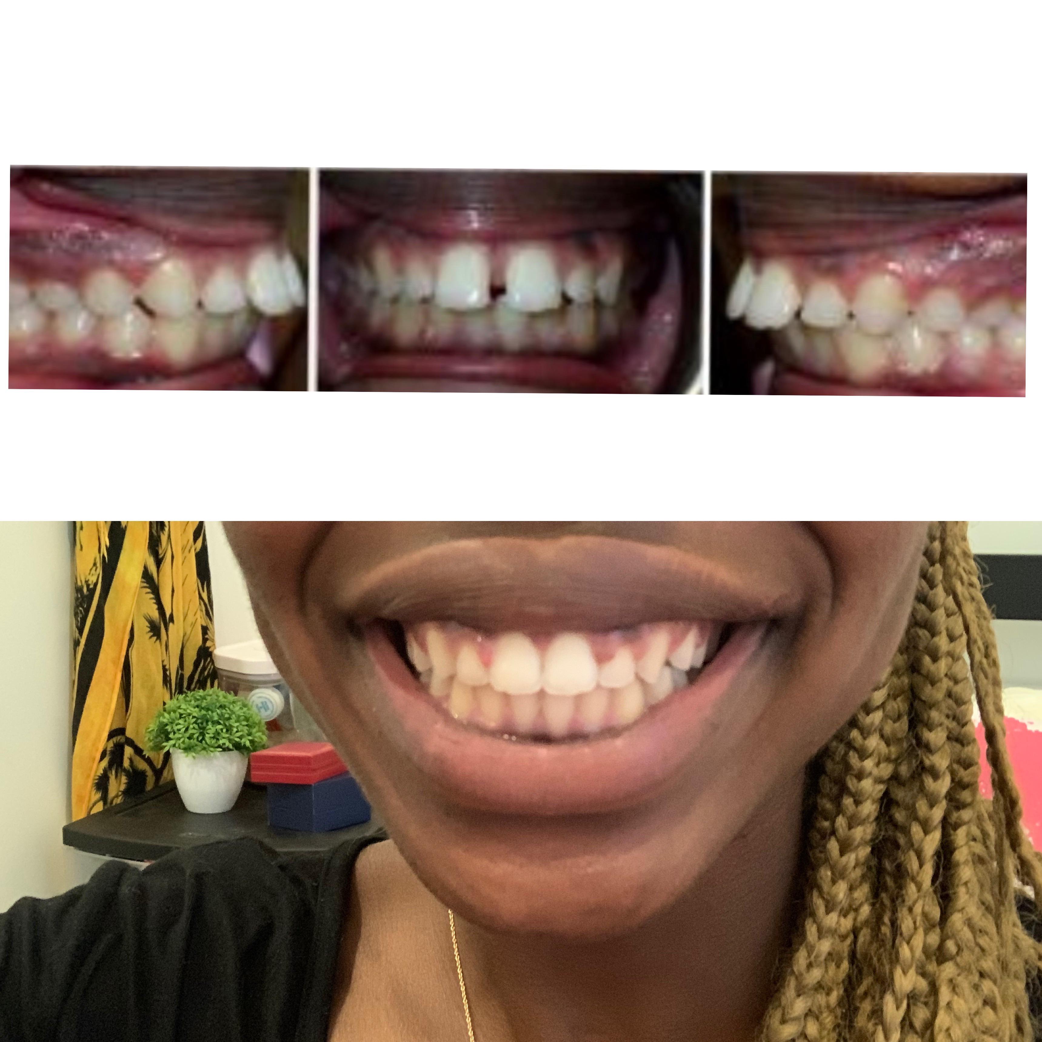 Braces Off After 22 Months Help W Gum Swellingbleeding Scrolller