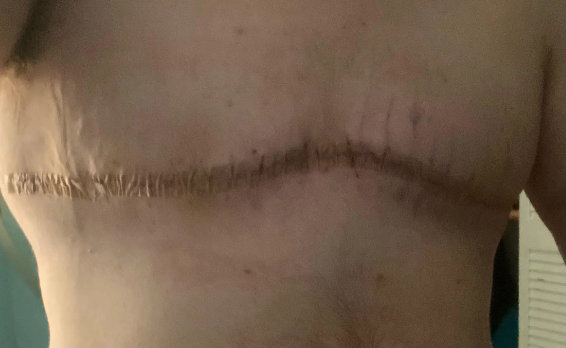 Puckered Incision Double Incision Gender Affirmation Surgery (Trans Male, 7 days post-op ...