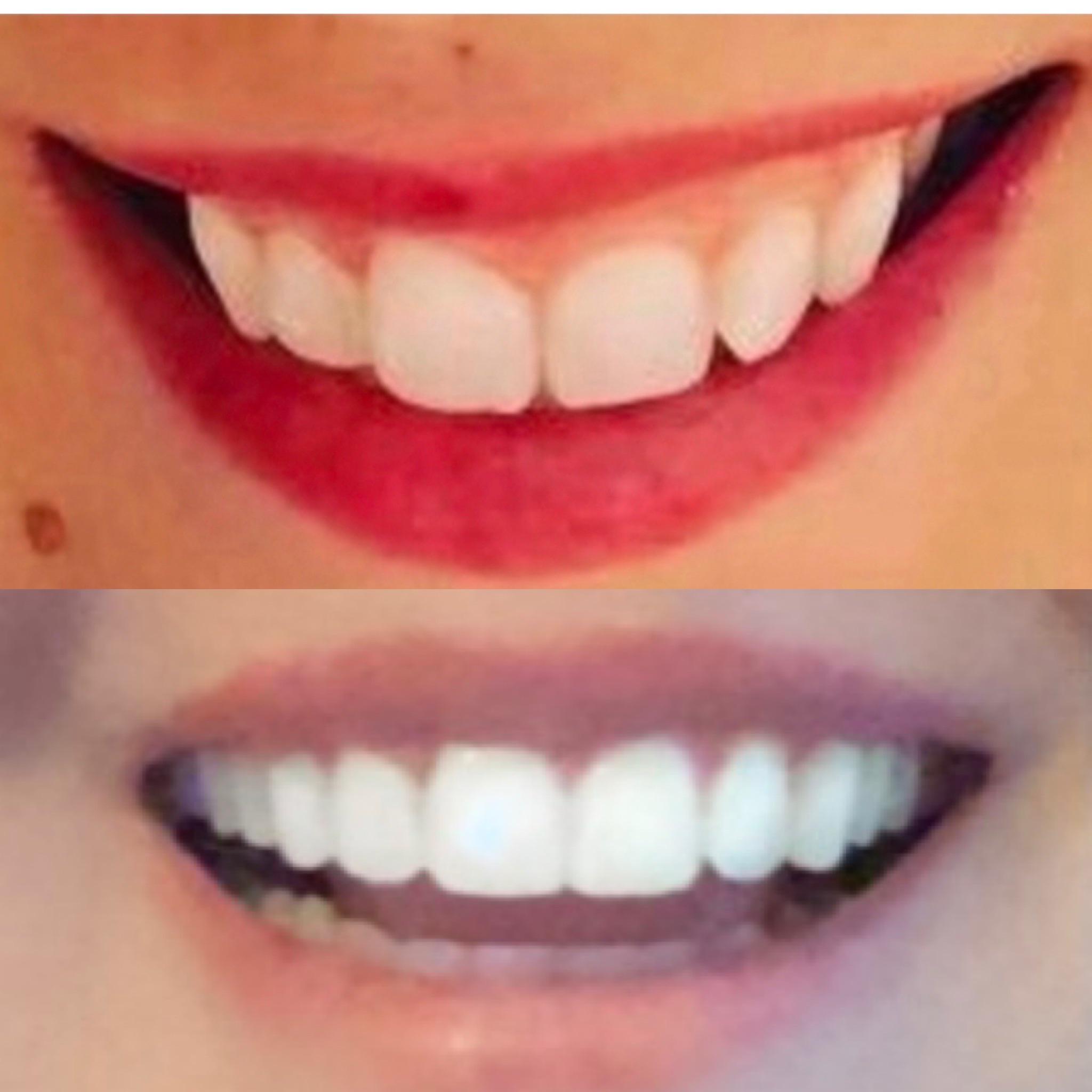 Final result! 10 month treatment, tooth shaping and whitening. Denver